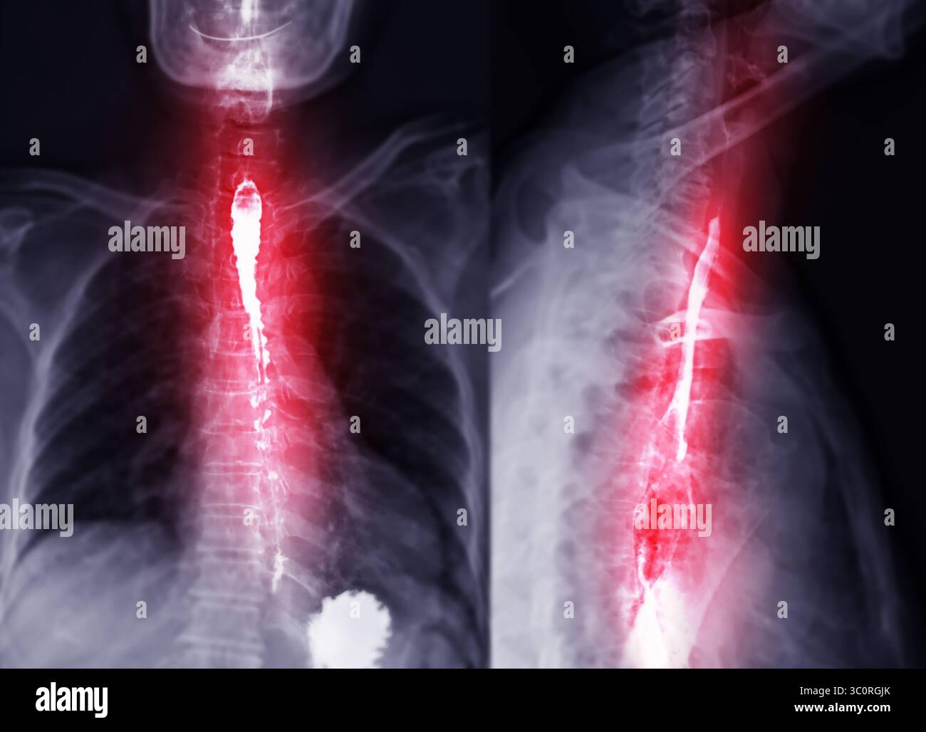 Barium Swallow Test