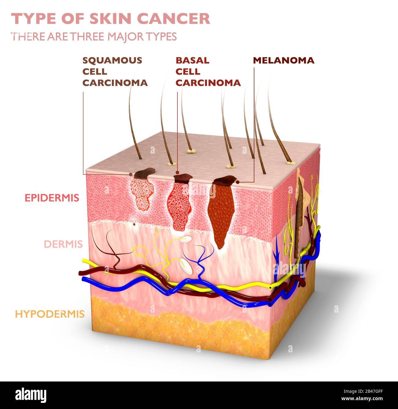 Basal Cell Carcinoma Malignant Melanoma