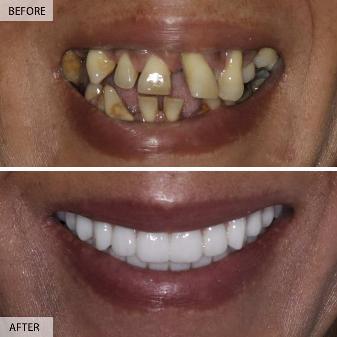 Before And After Dental Implants
