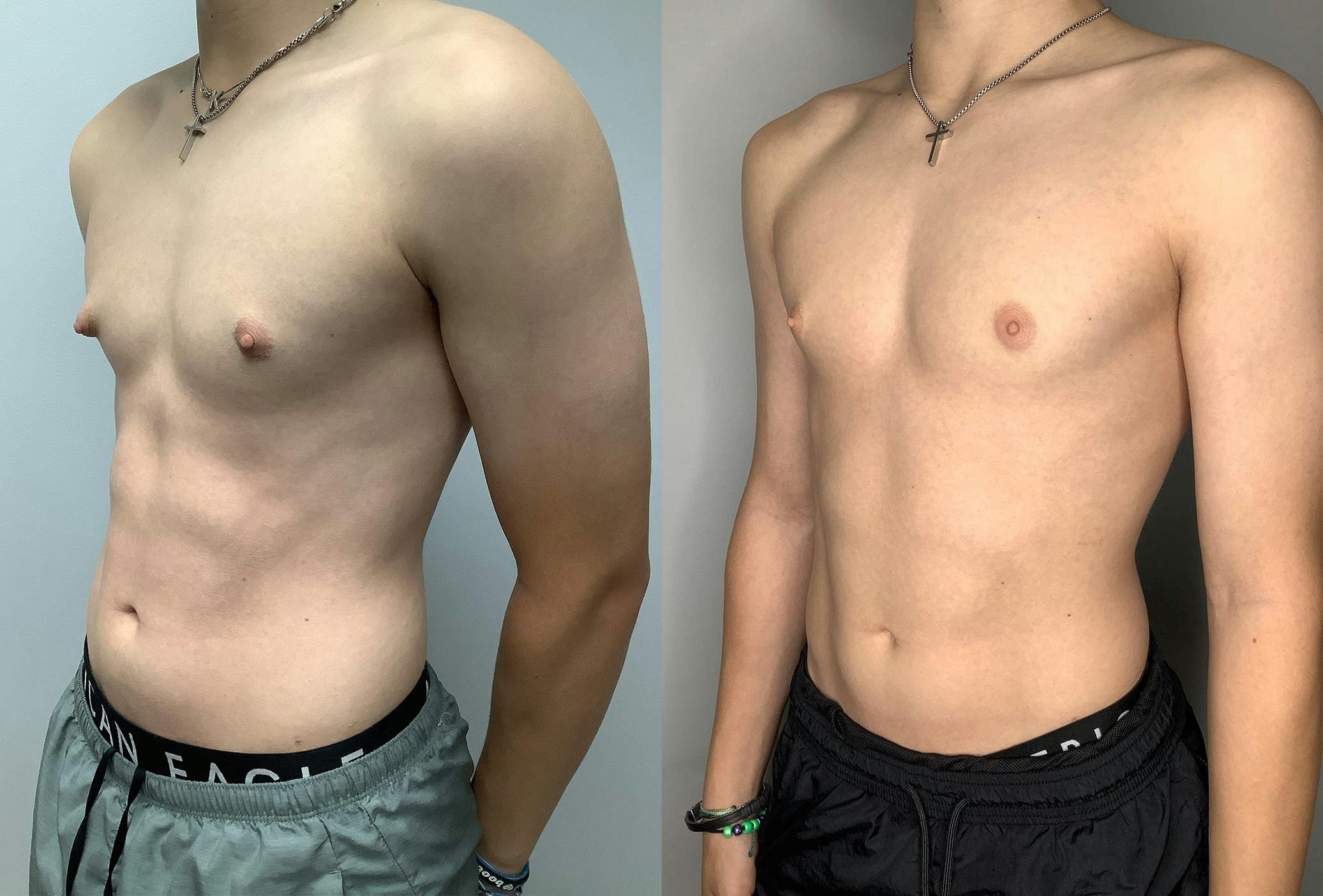 Before And After Gynaecomastia Surgery