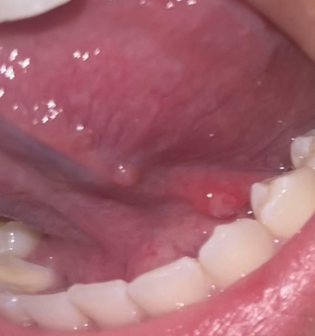 Below Tongue Bumps