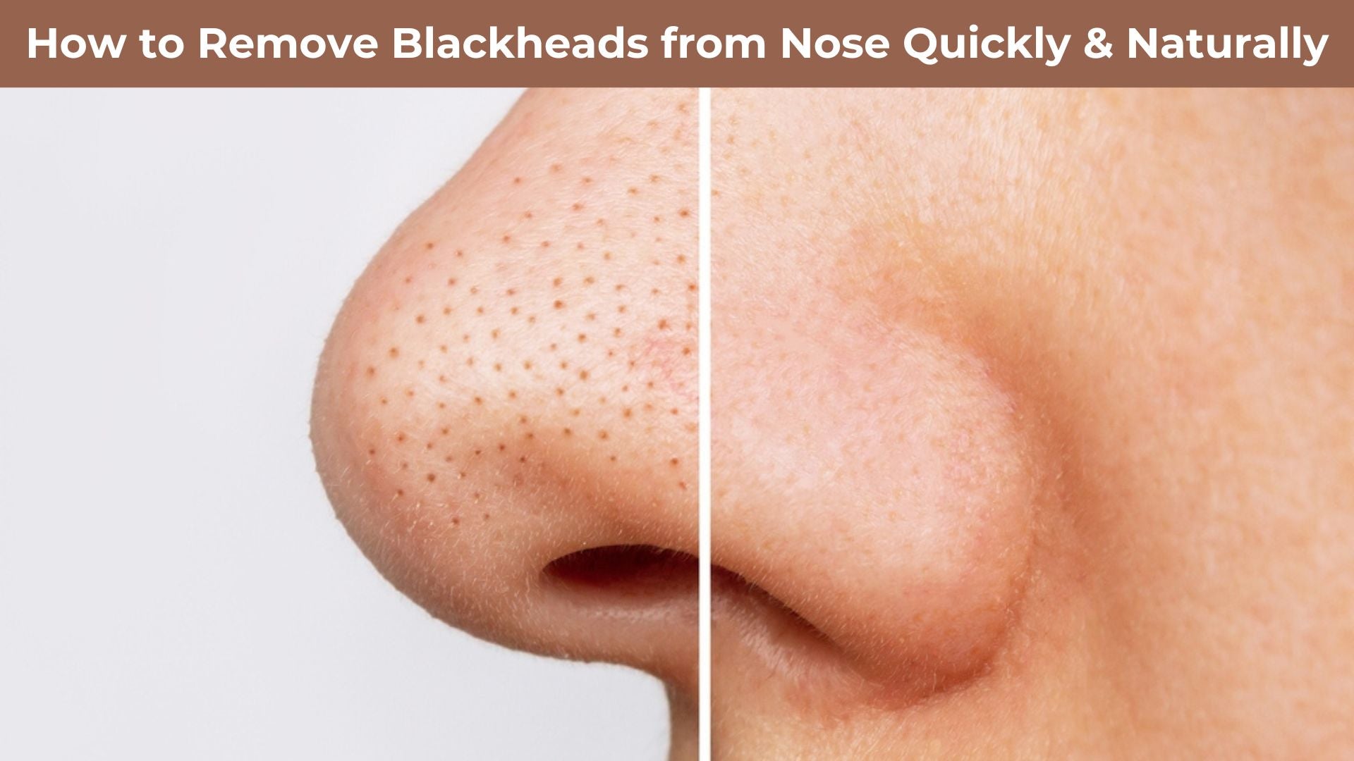 Best Way To Remove Blackheads