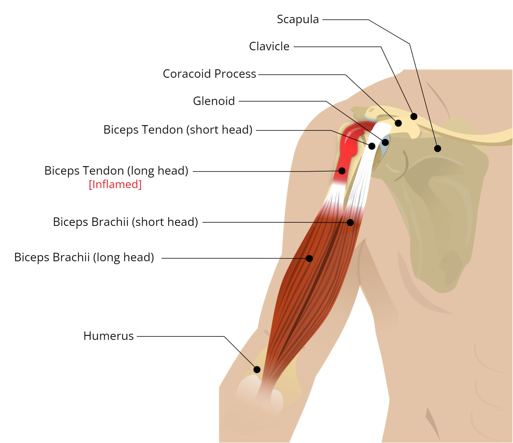 Biceps Muscle Tendonitis