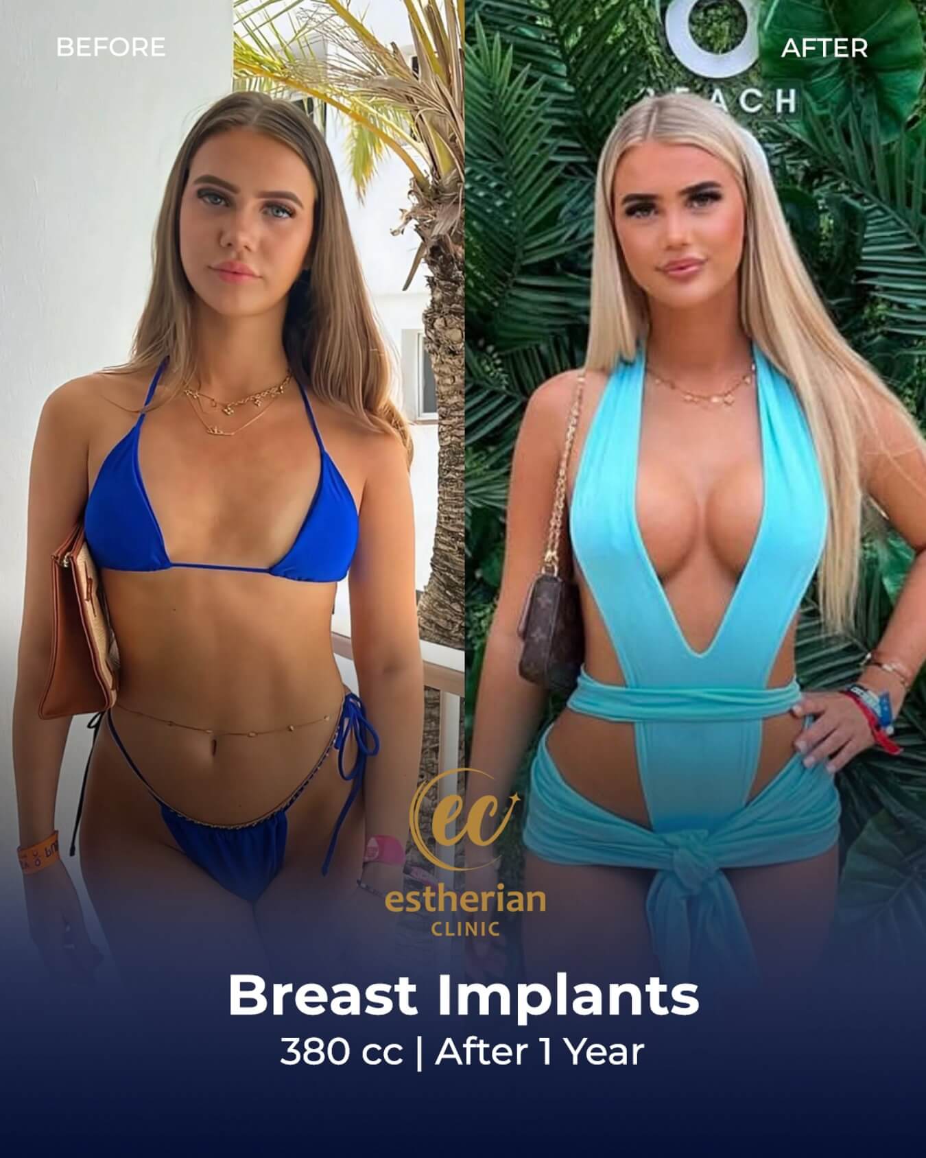 Big Implant Breast