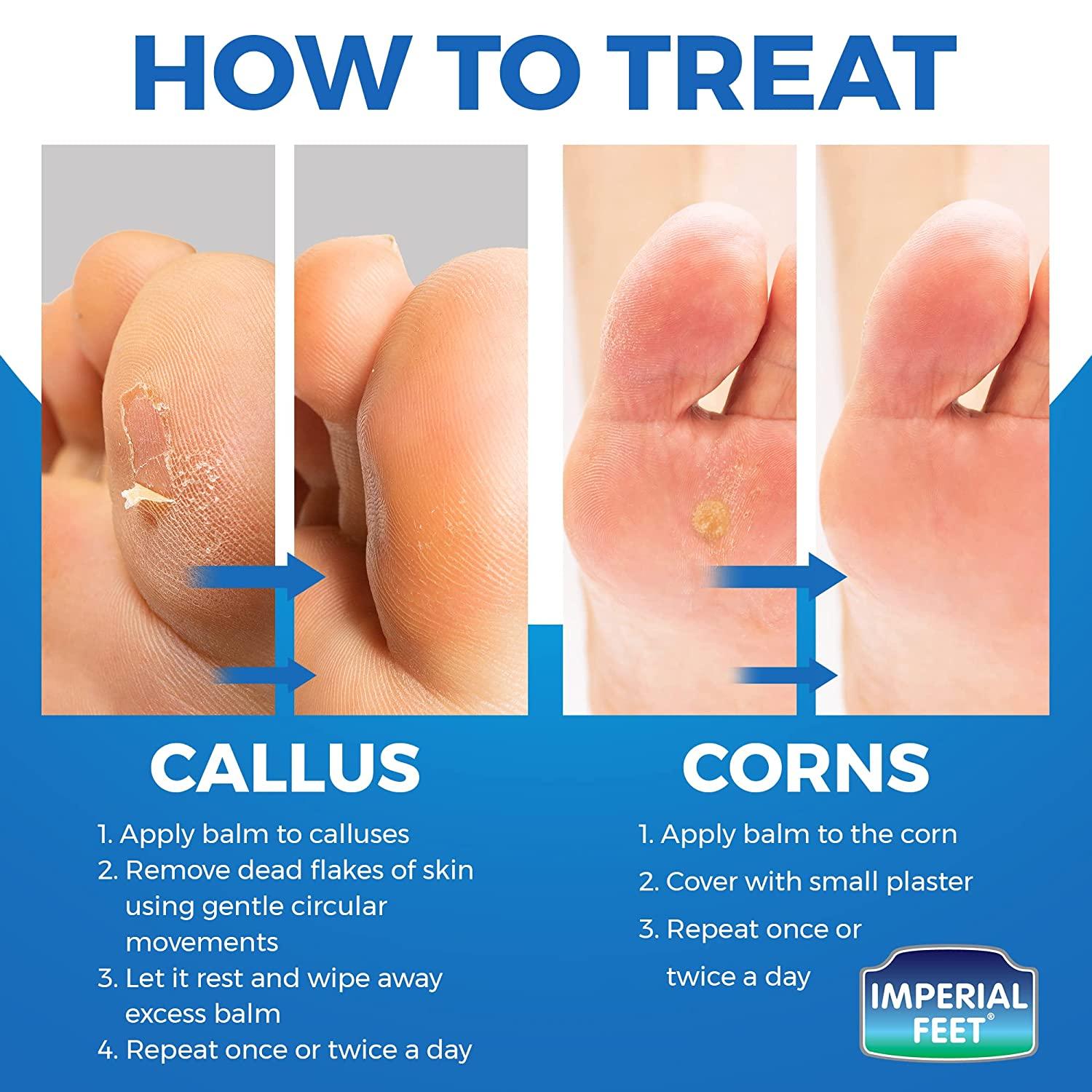 Big Toe Callus Removal