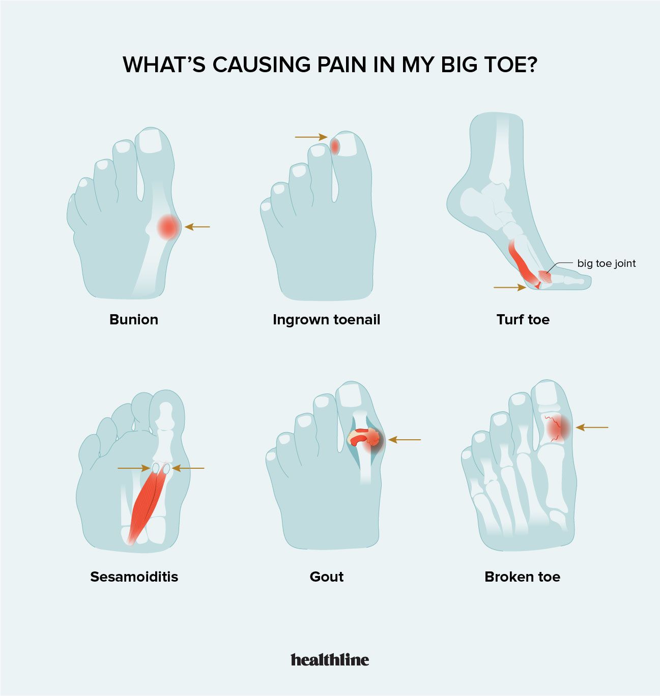 Big Toe Discomfort