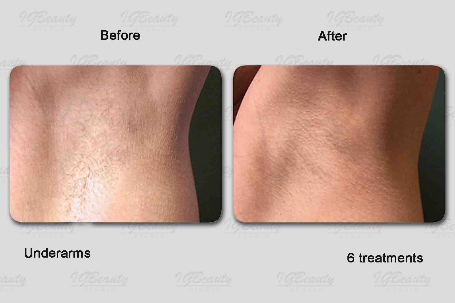 Bikini Line Laser Hair Removal