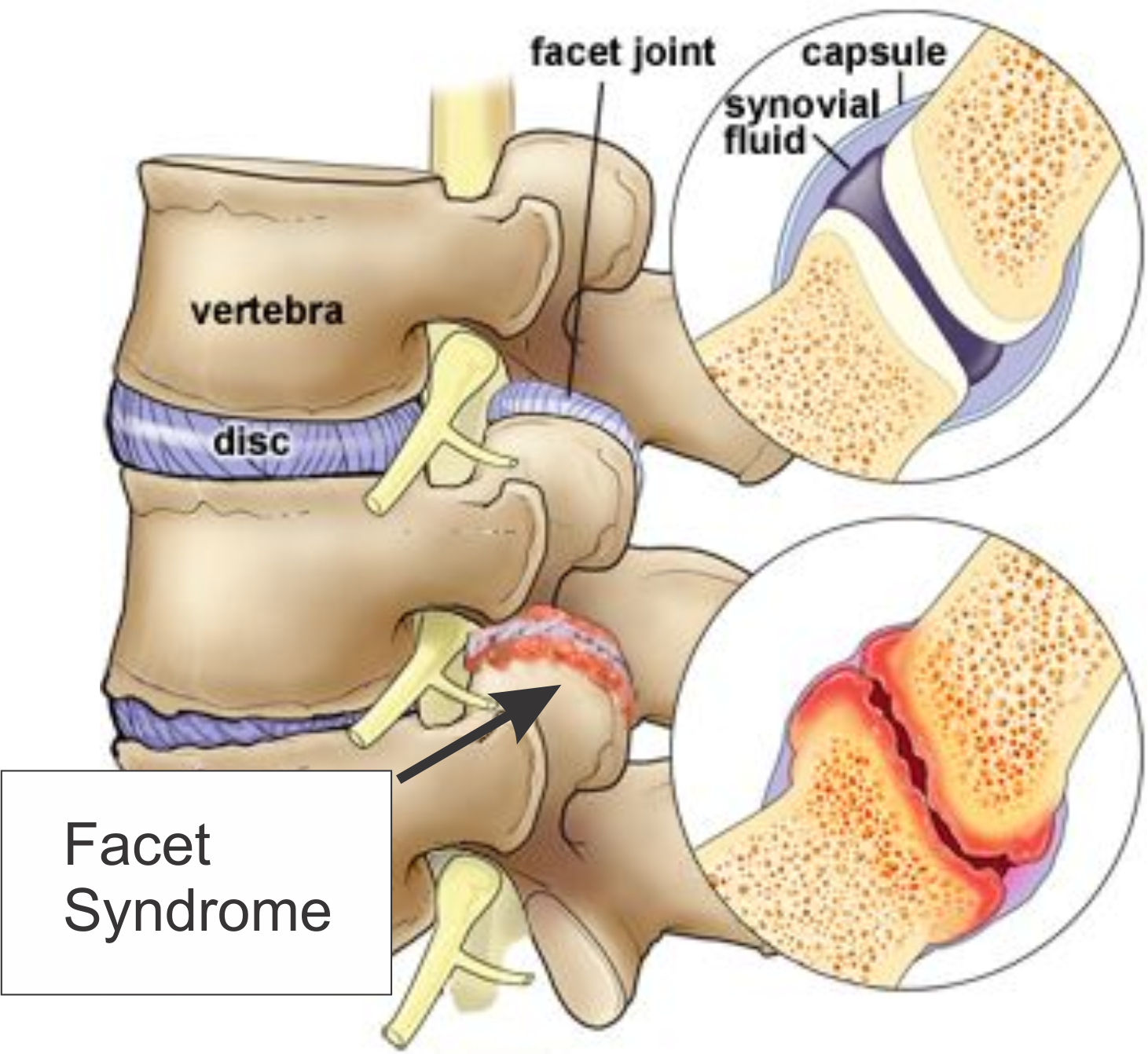 Bilateral Facet Arthropathy