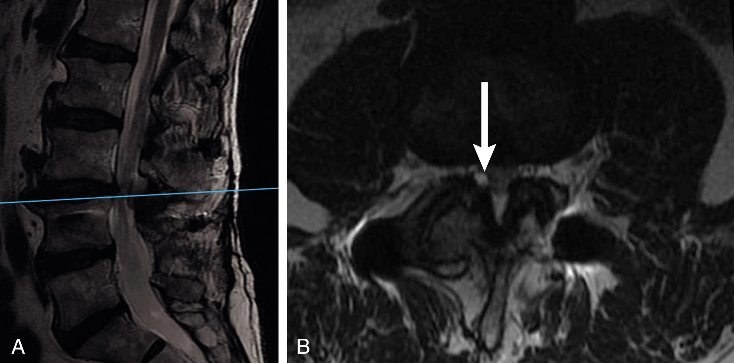 Bilateral Facet Hypertrophy
