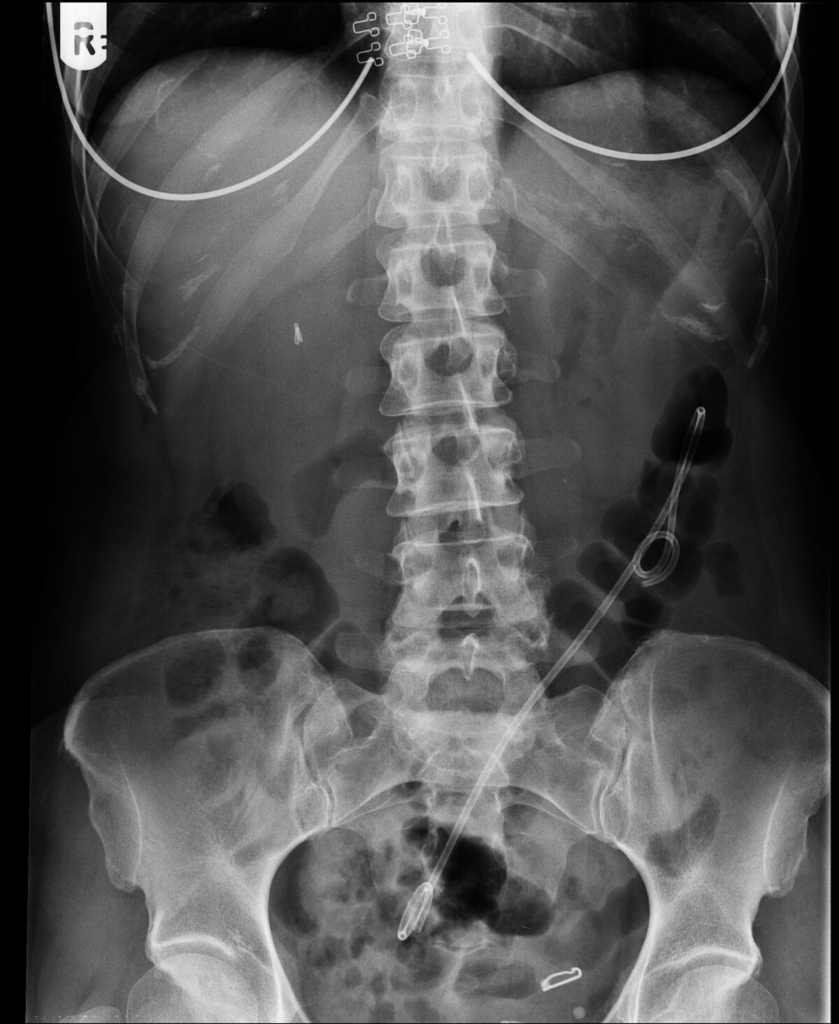 Bile Duct Stent