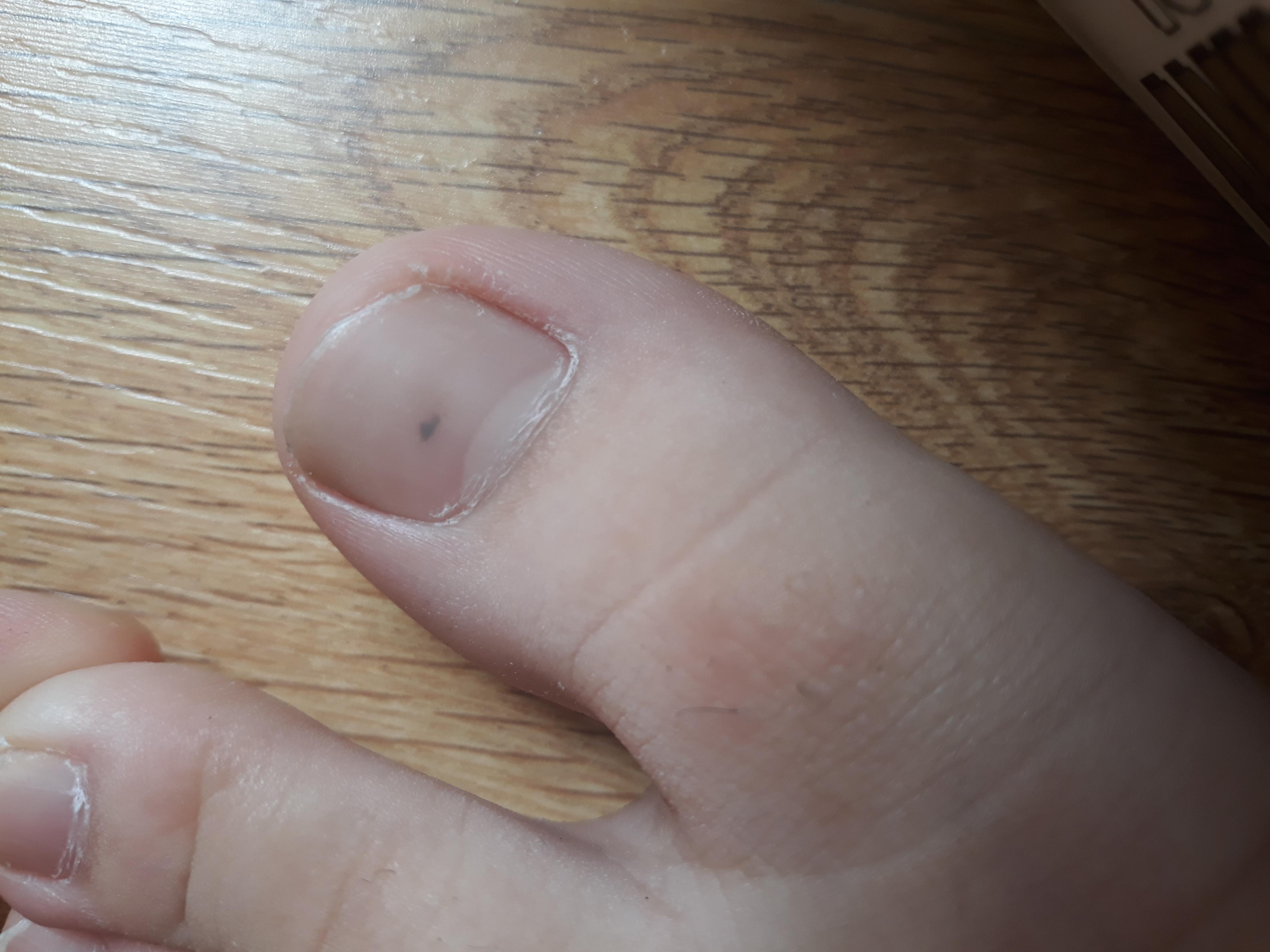 Black Dot On Toenail