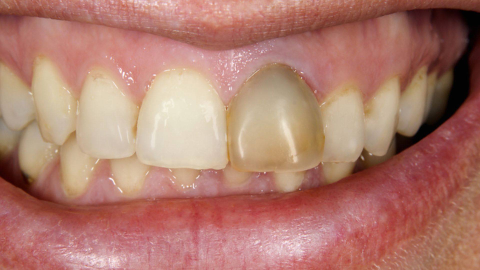 Black Marks On Teeth