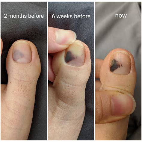 Black Spot On Toenail