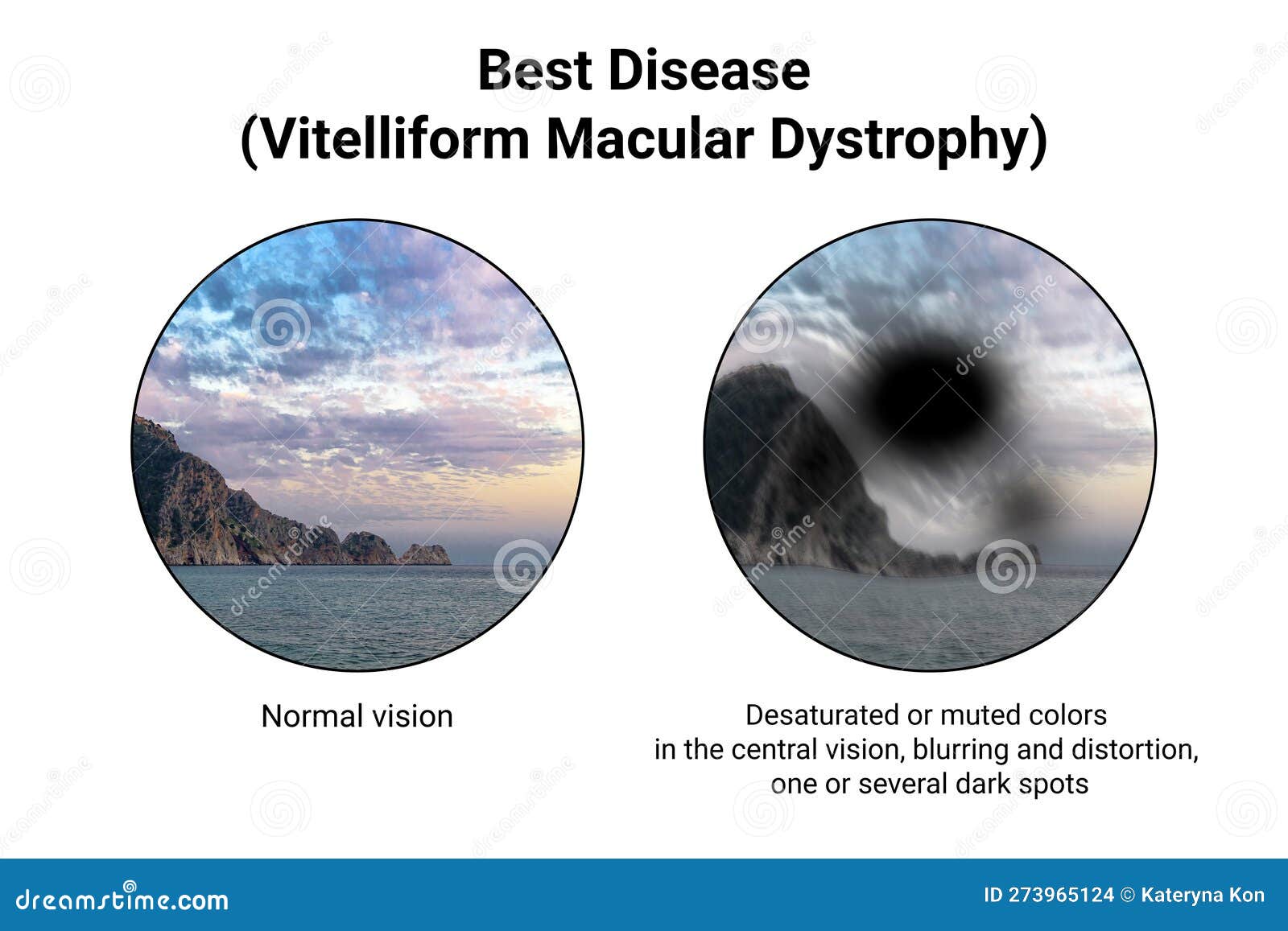 Black Spot When Seeing