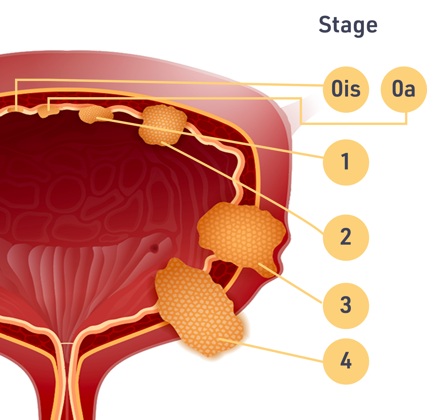 Bladder Tumor Staging