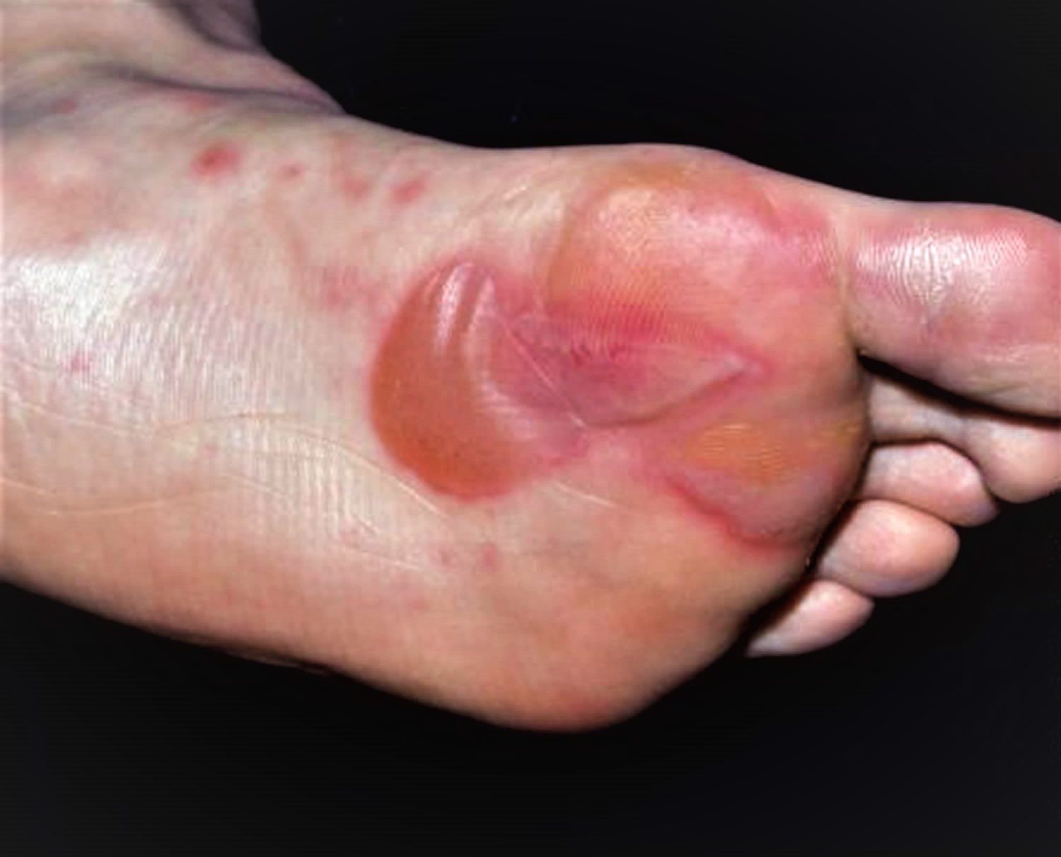 Blister On The Feet