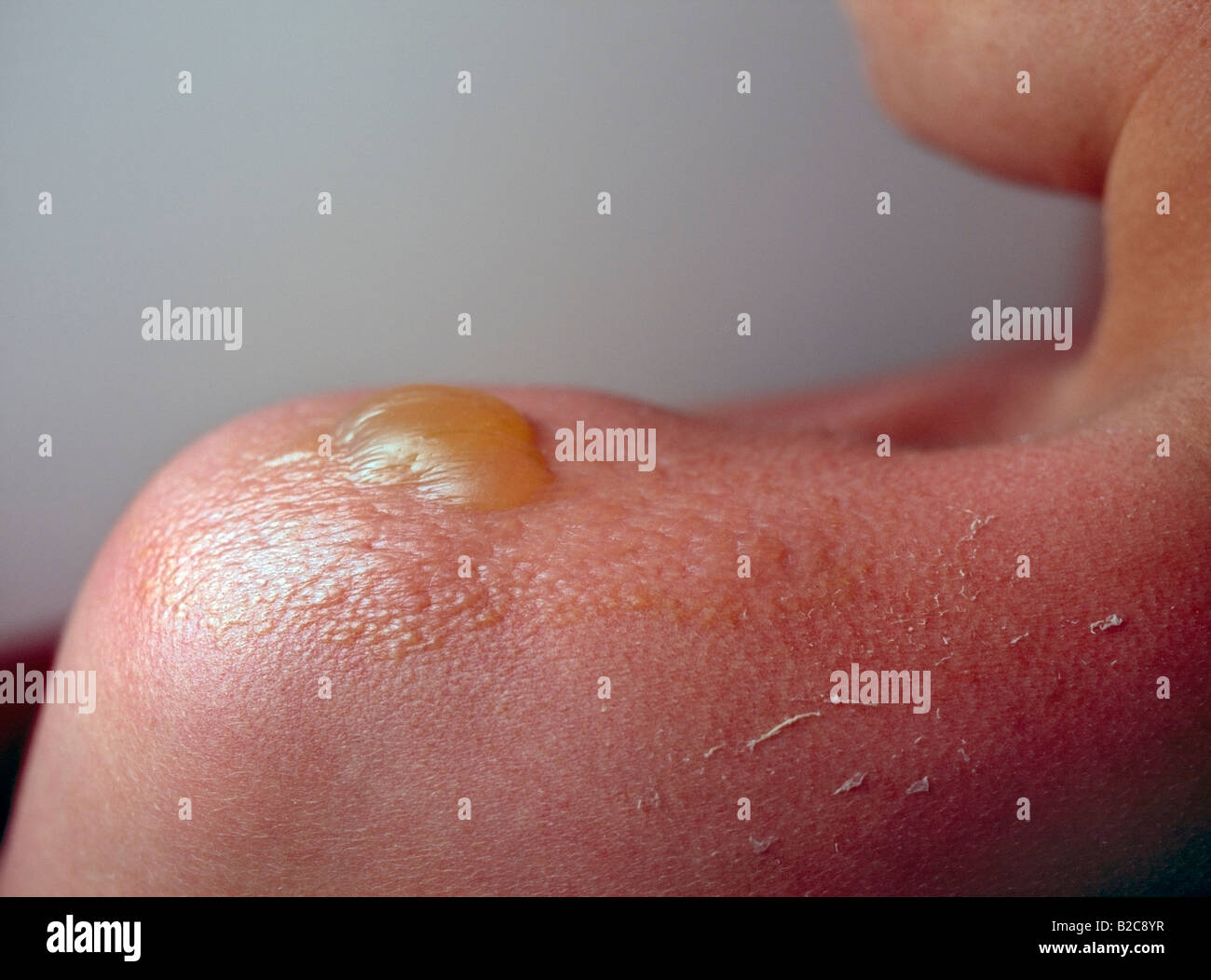 Blisters From Sunburn