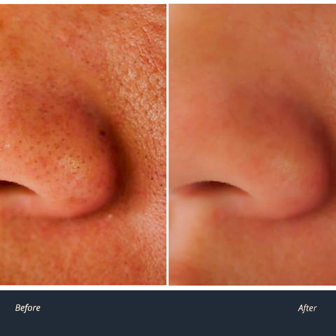 Block Pores Face