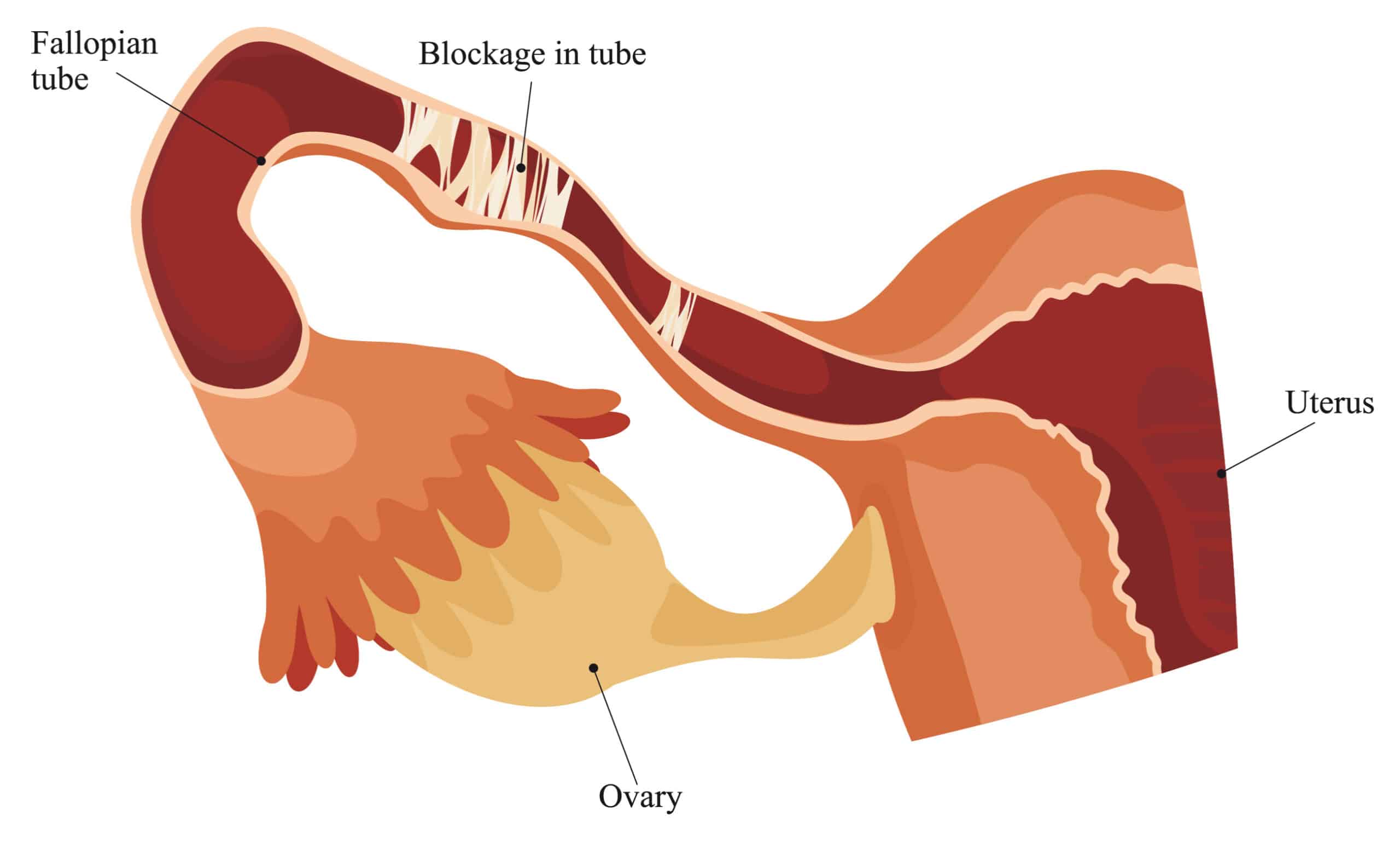 Blocked Fallopian Tube