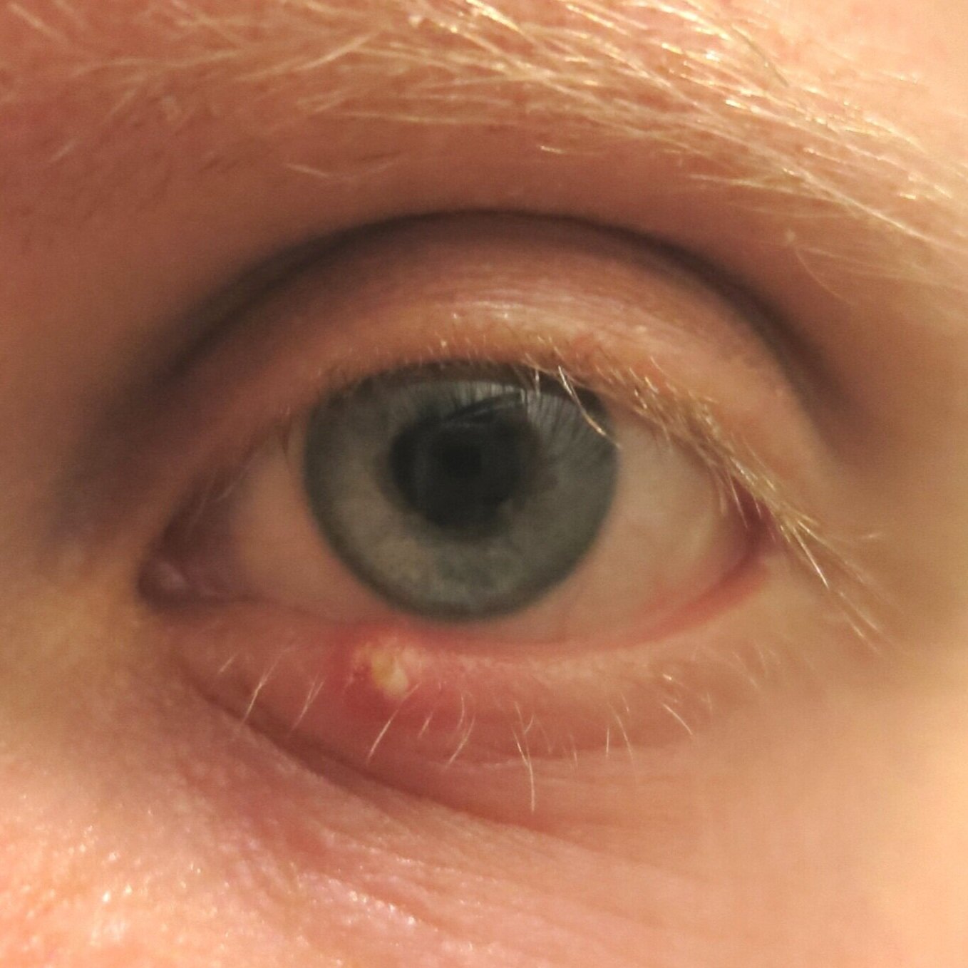 Blocked Oil Gland Eyelid