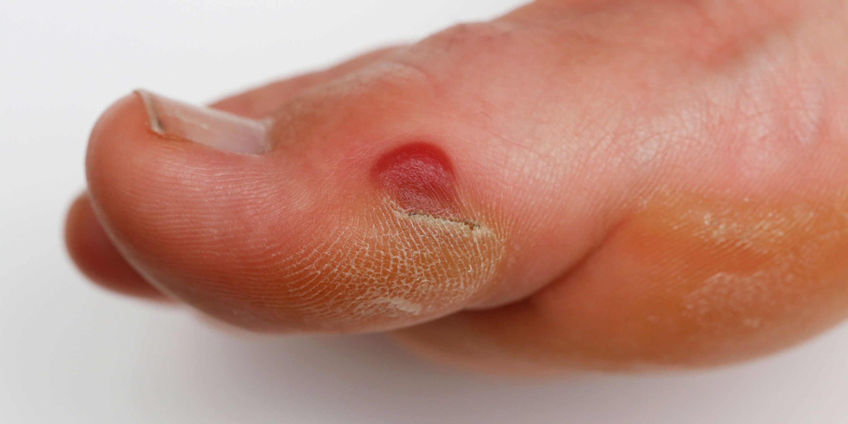 Blood Blisters On Feet