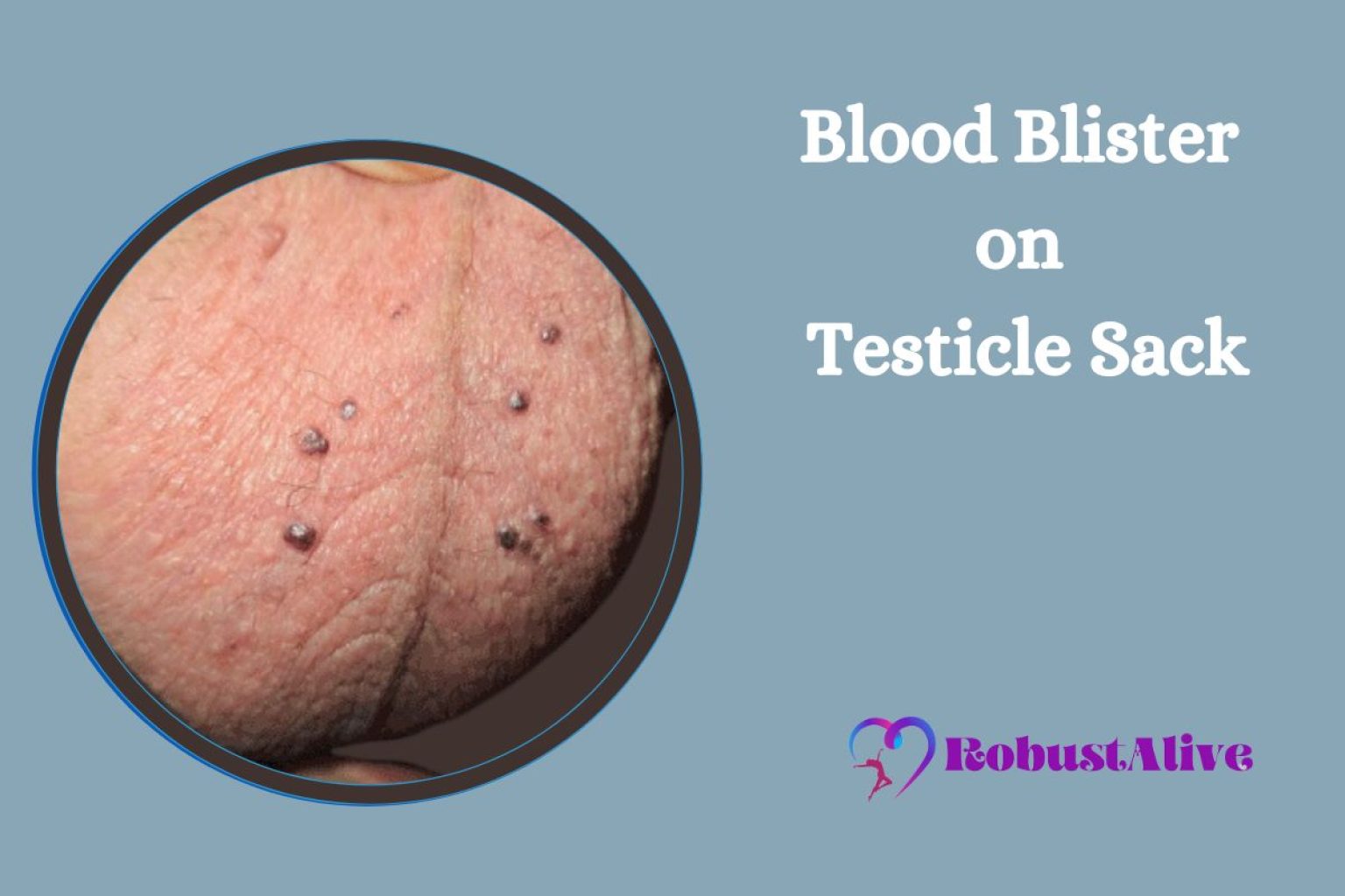 Blood Blisters On Scrotum