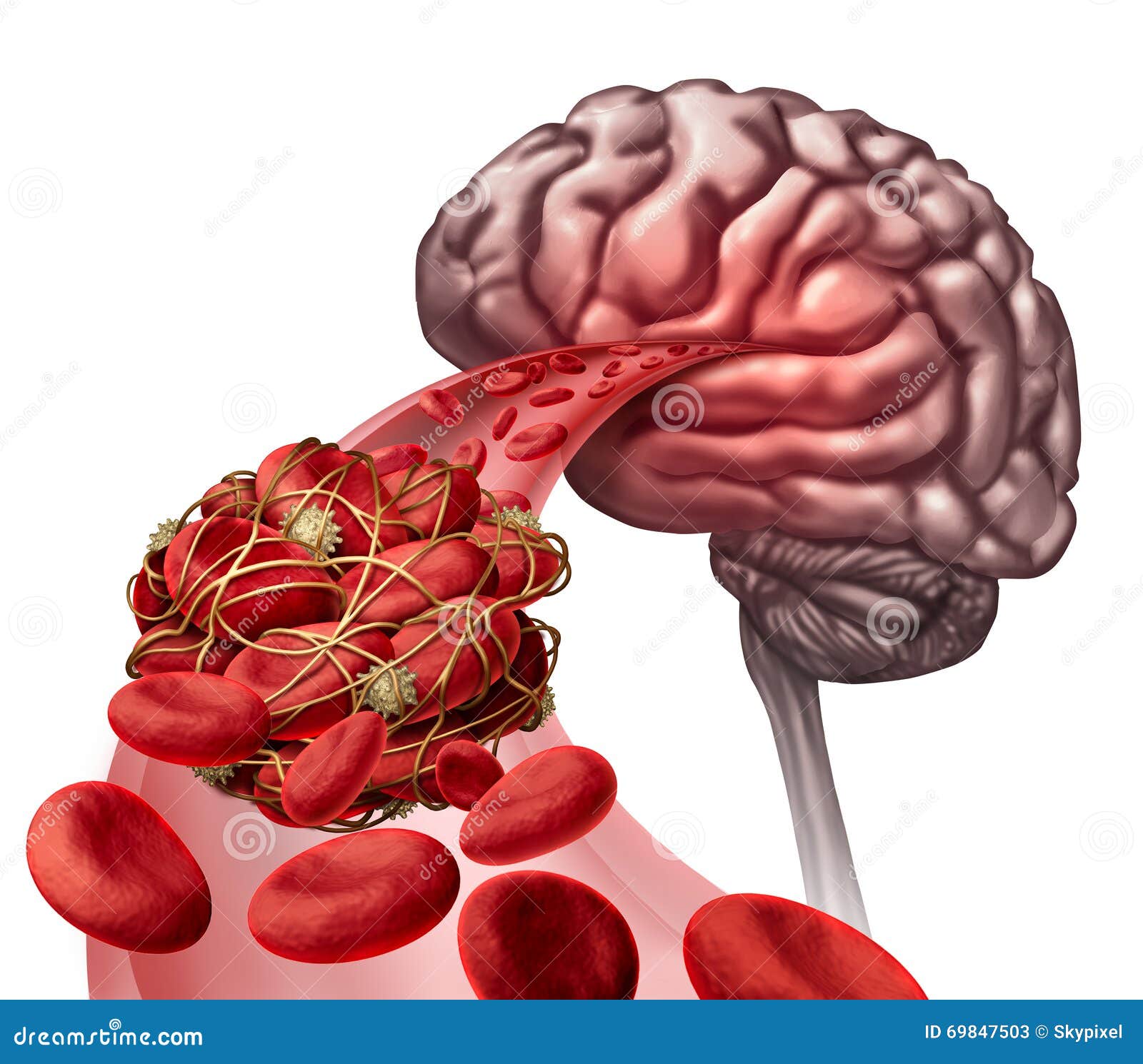 Blood Clot In Brain