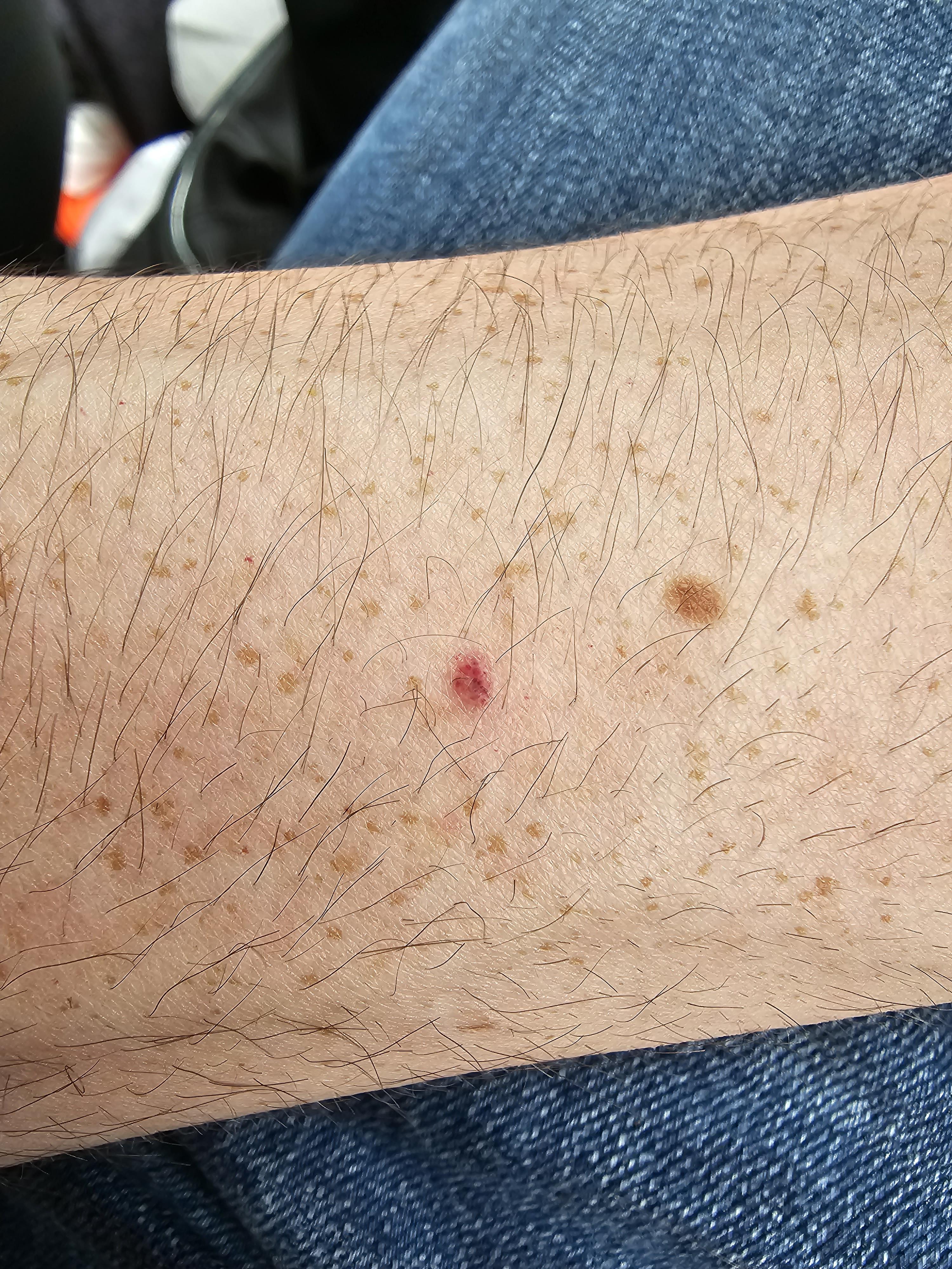 Blood Filled Spot
