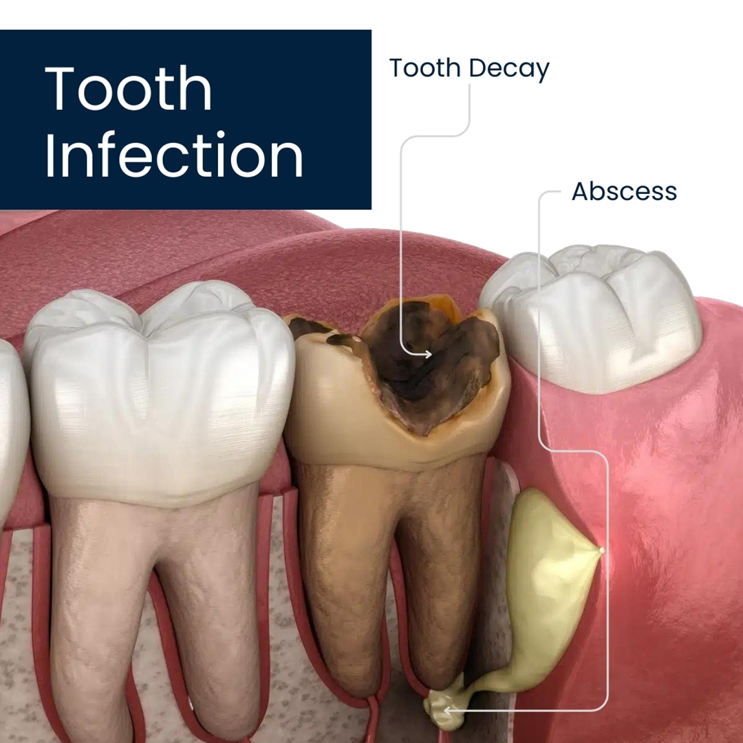 Blood Infection From Tooth Infection