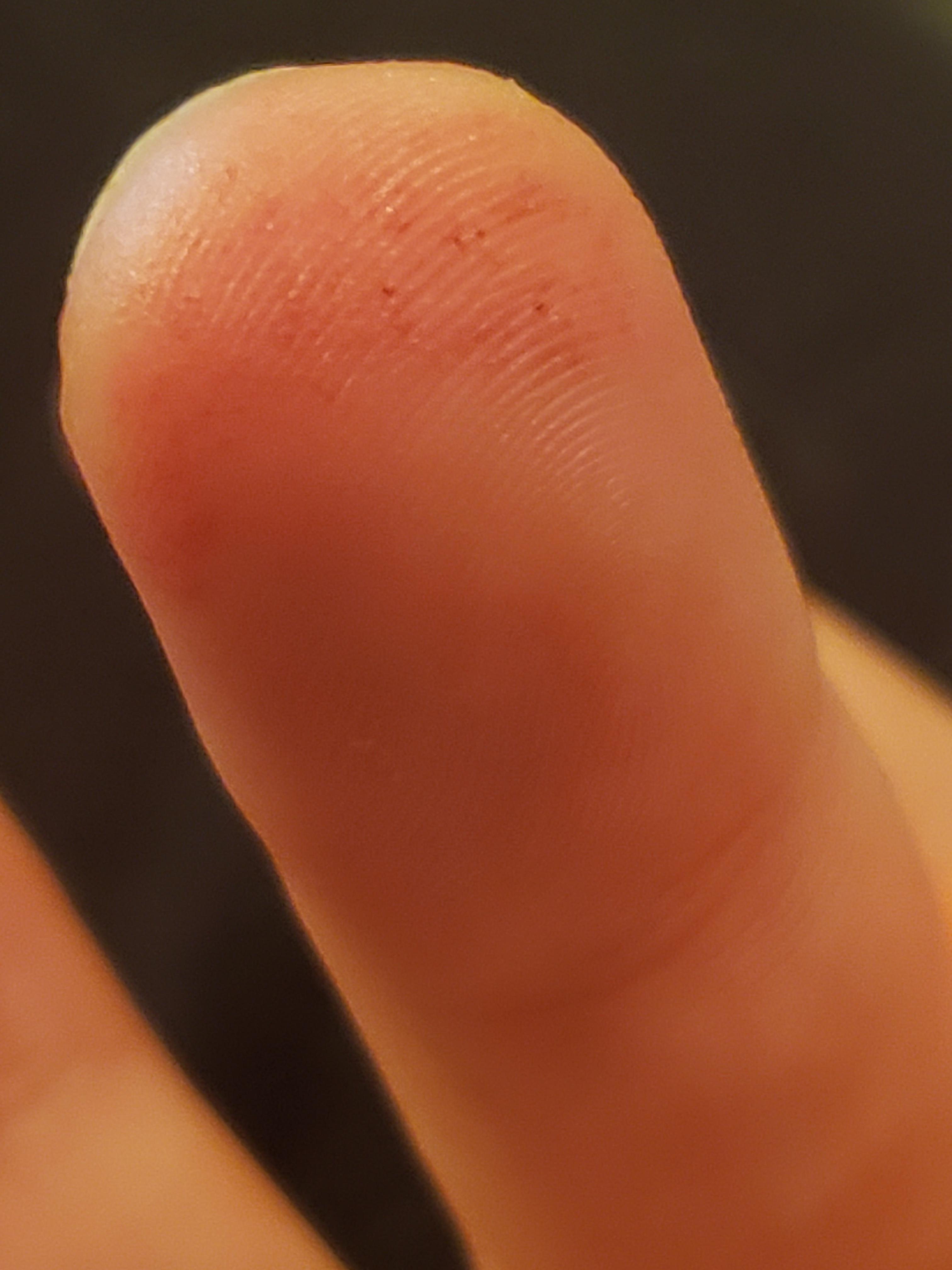 Blood Vessel Rupture In Finger