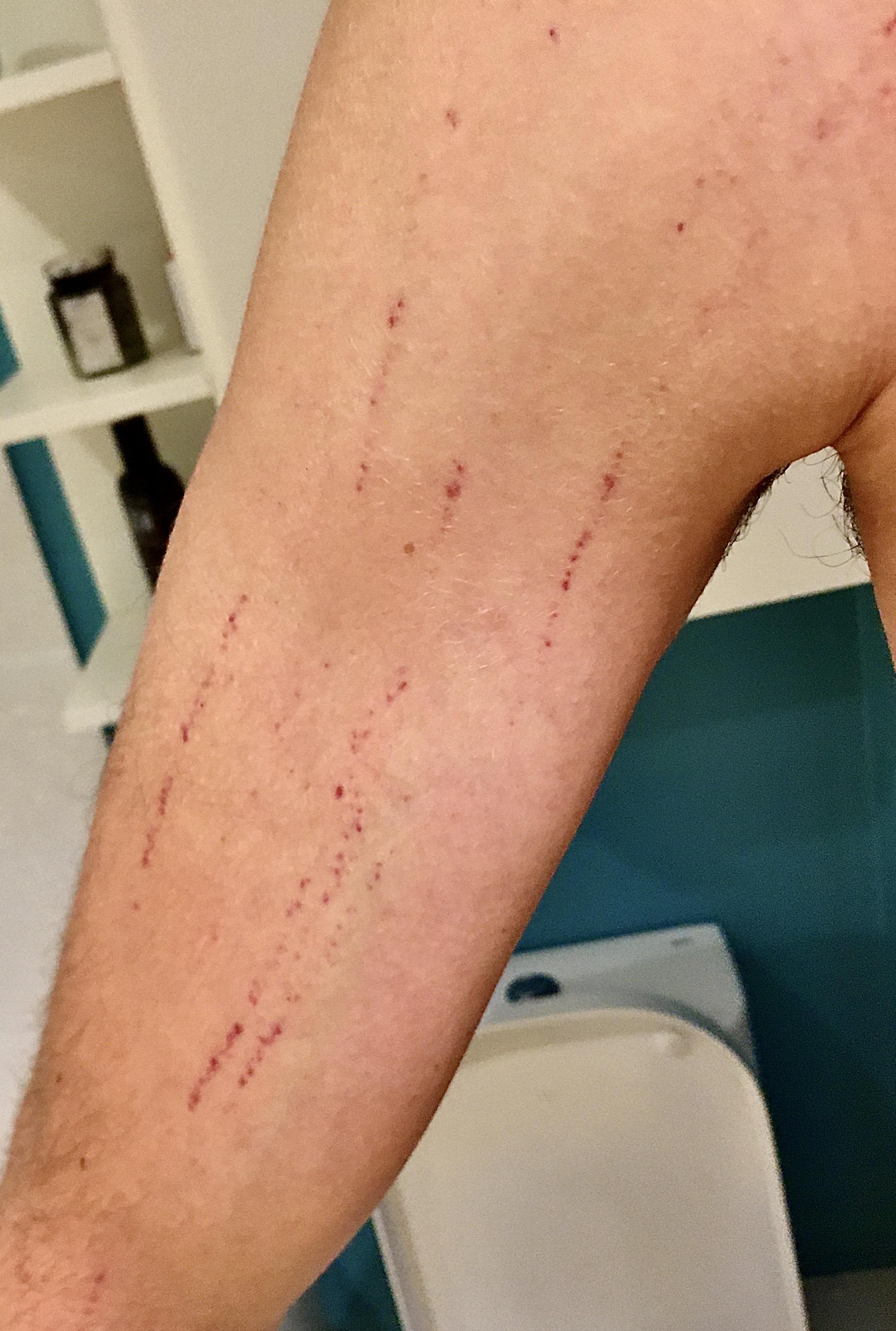 Blood Vessels Popped In Arm
