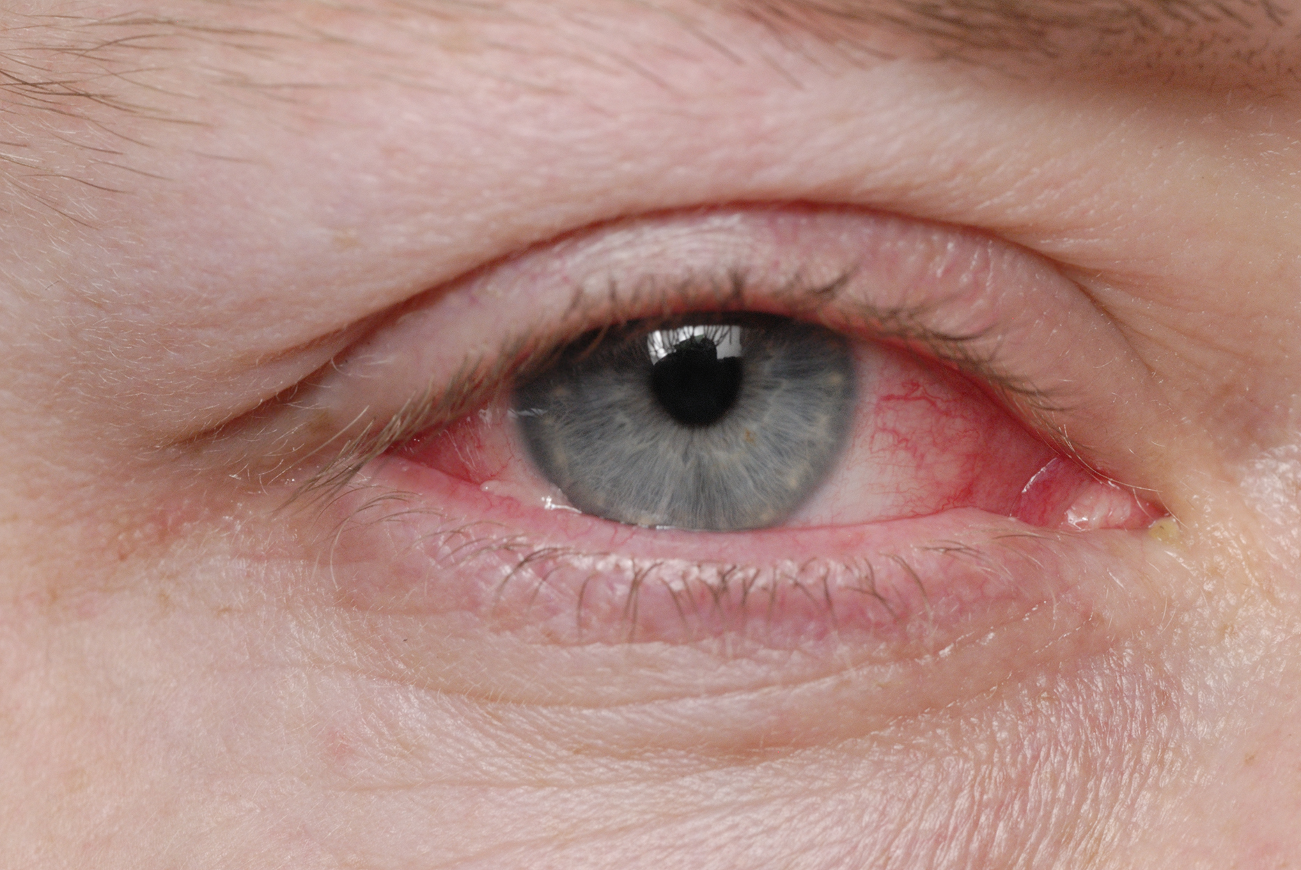 Blurred Eyes During Pregnancy