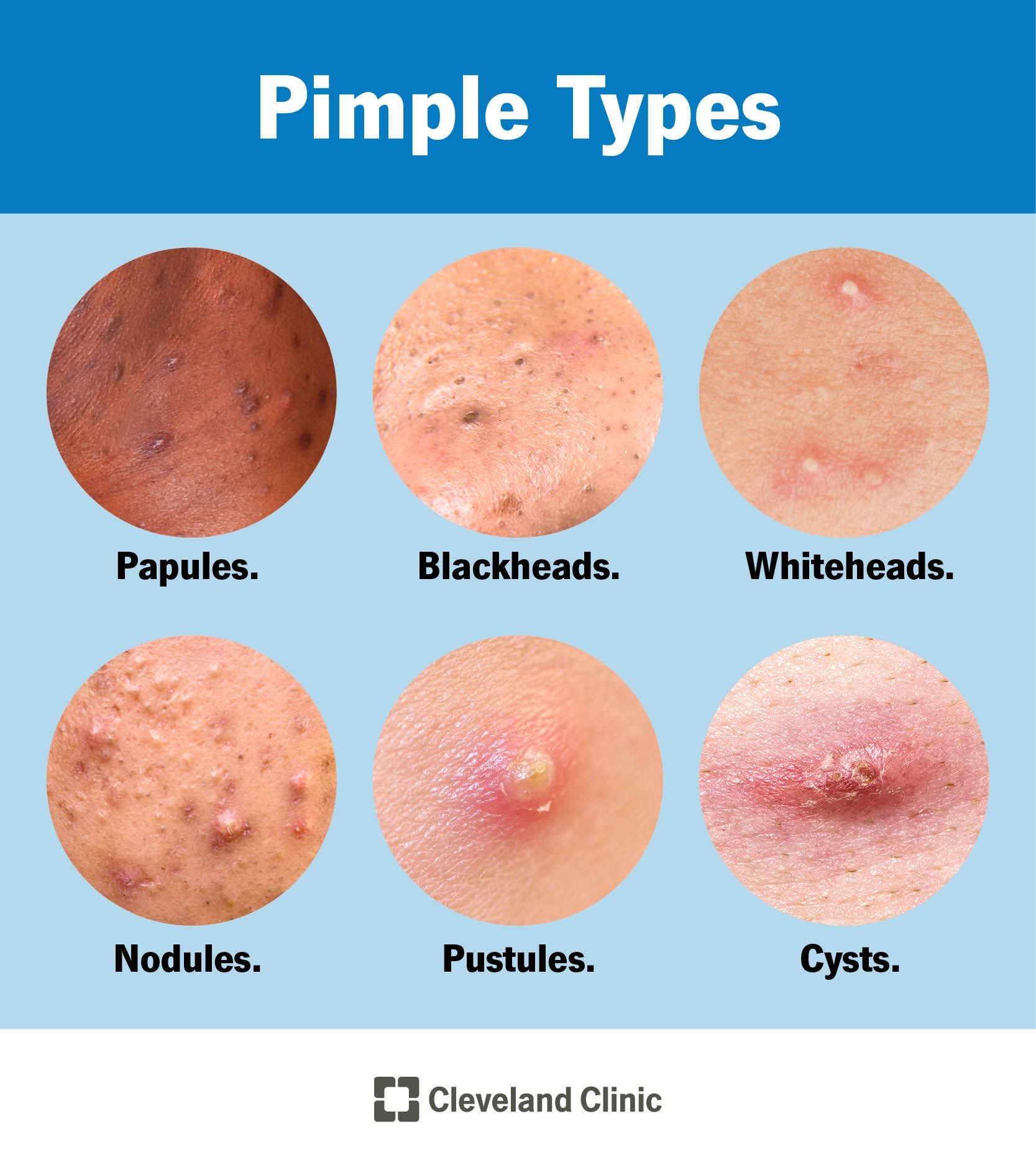 Boil Or Pimple
