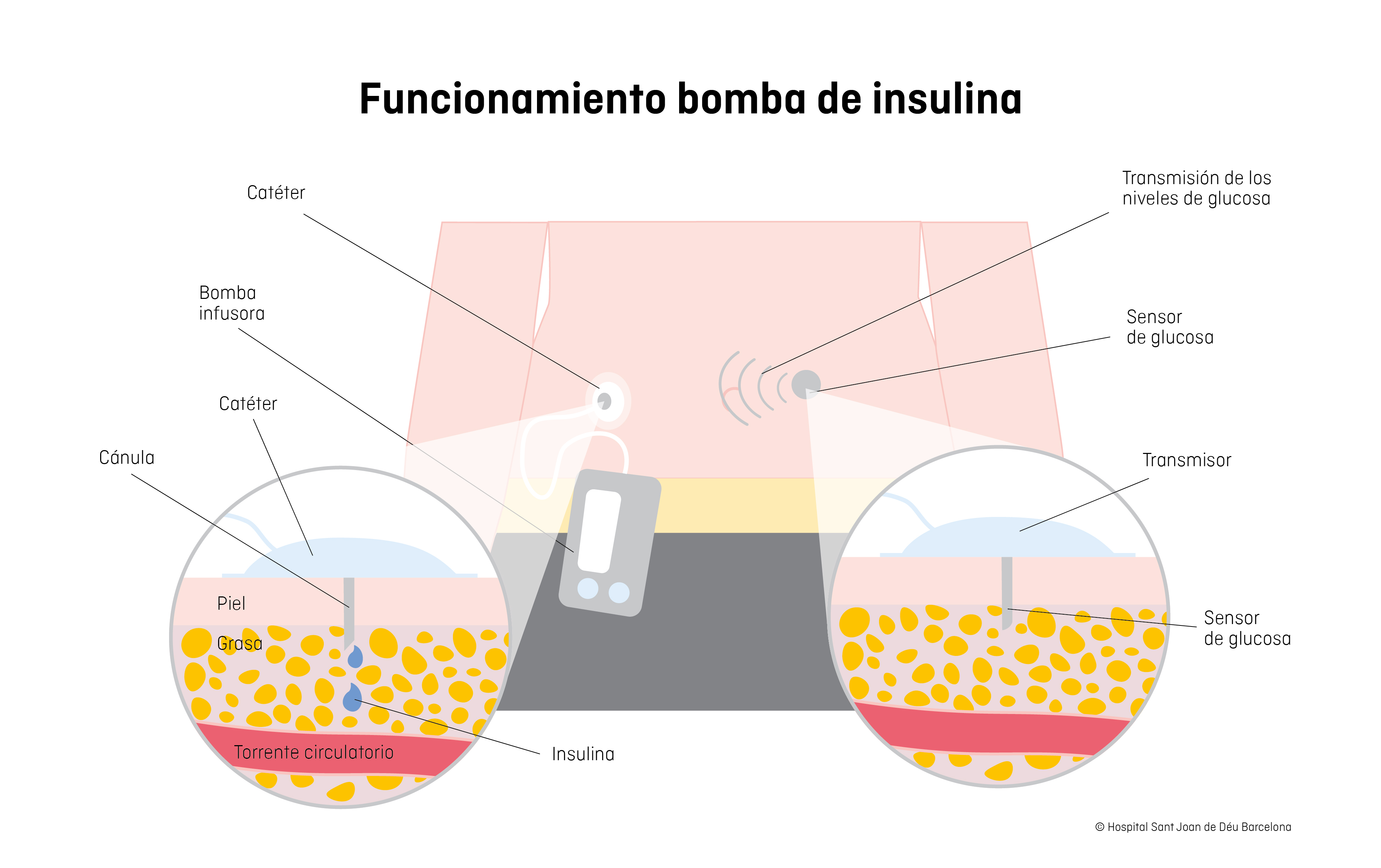 Bomba De Insulina