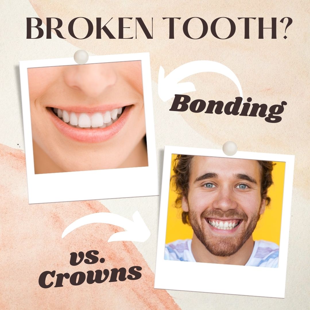 Bonded Tooth Broke