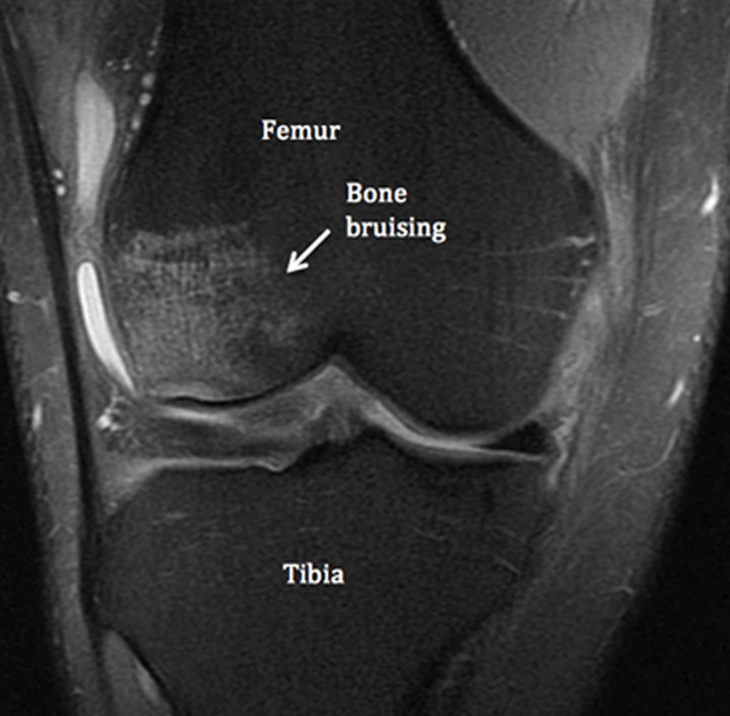 Bone Contusion Knee