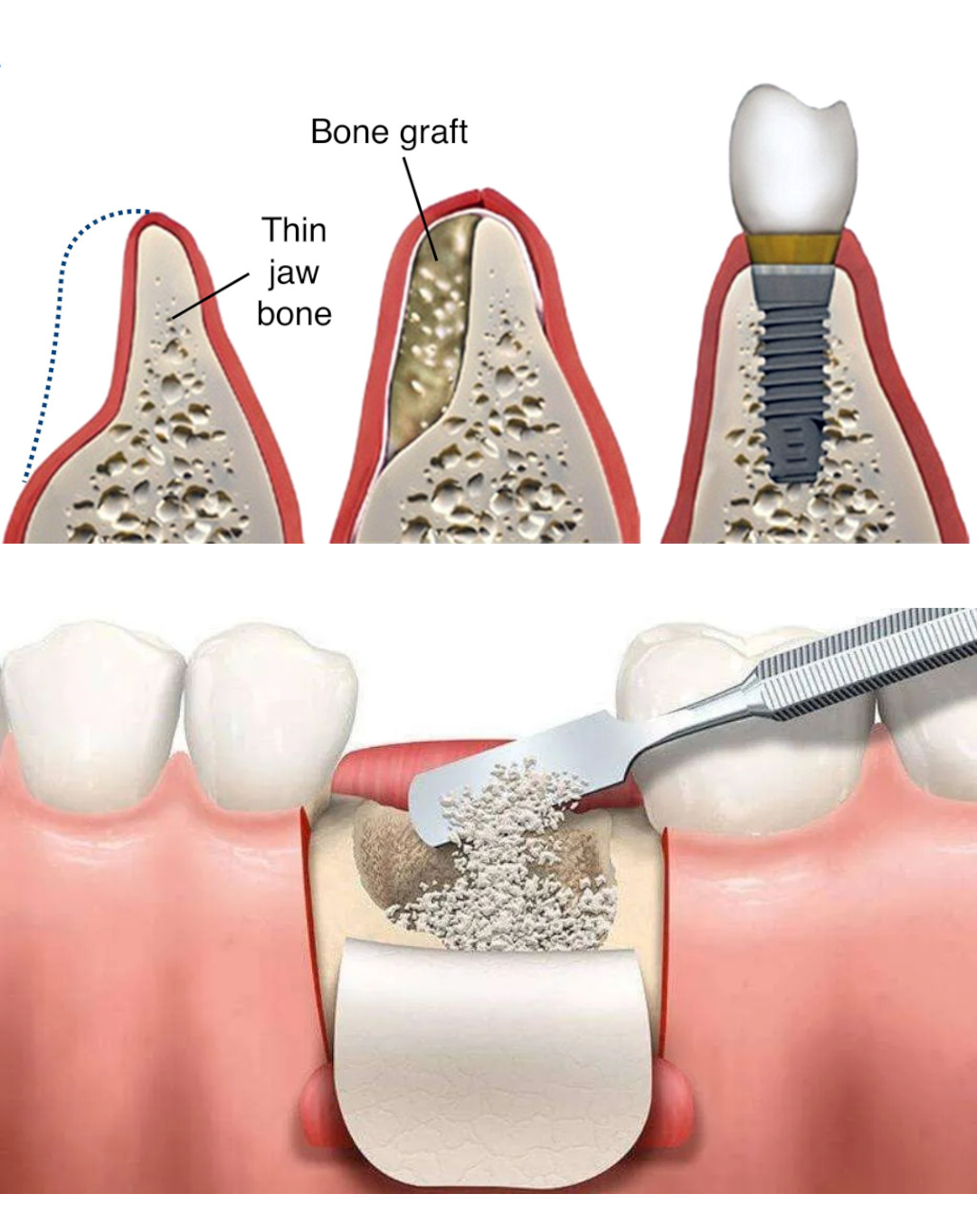 Bone Graft Tooth