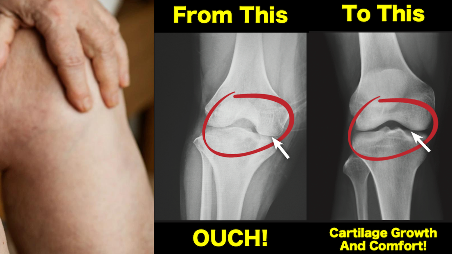 Bone In Knee Pain