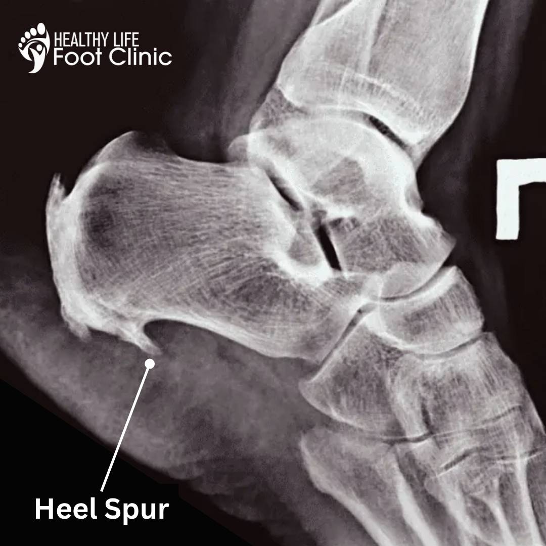 Bone Spur On Heel