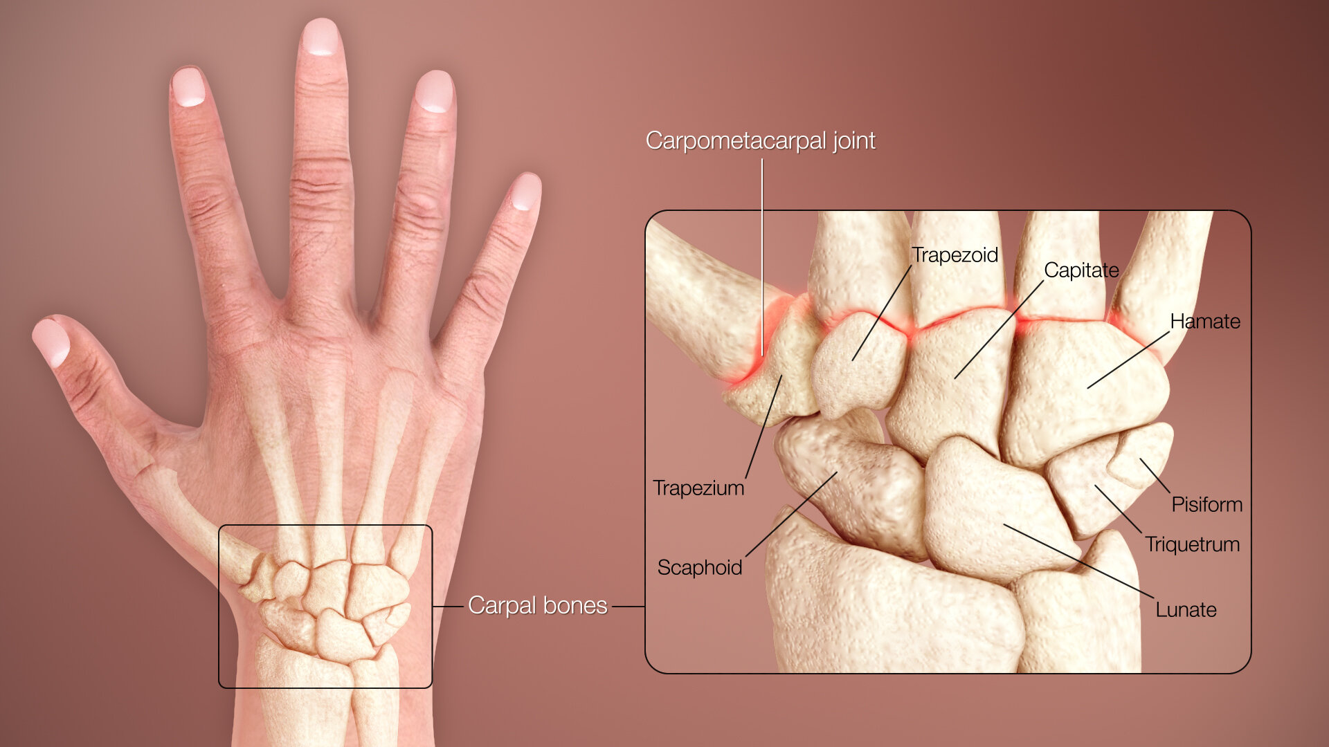 Bone Spur On Wrist