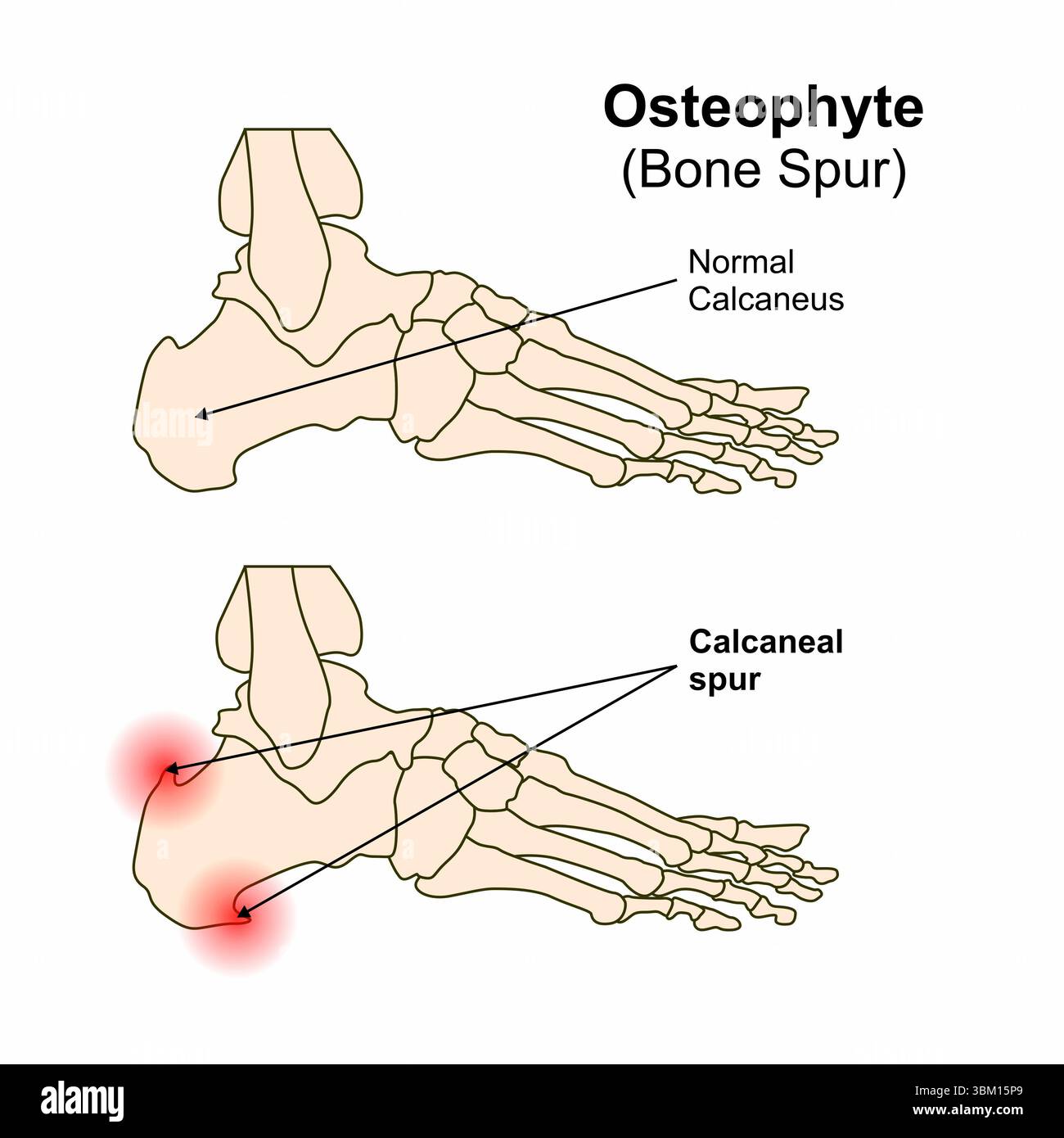 Bone Spurs And Osteophytes