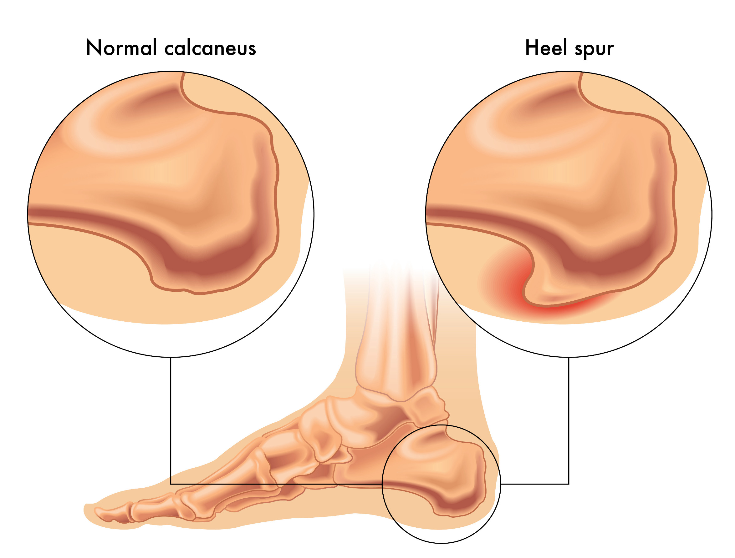 Bone Spurs In Heel