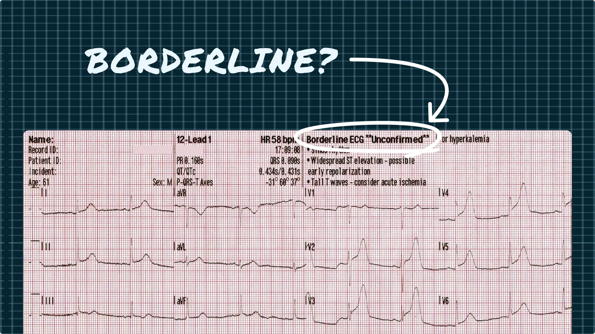 Borderline Ekg Means