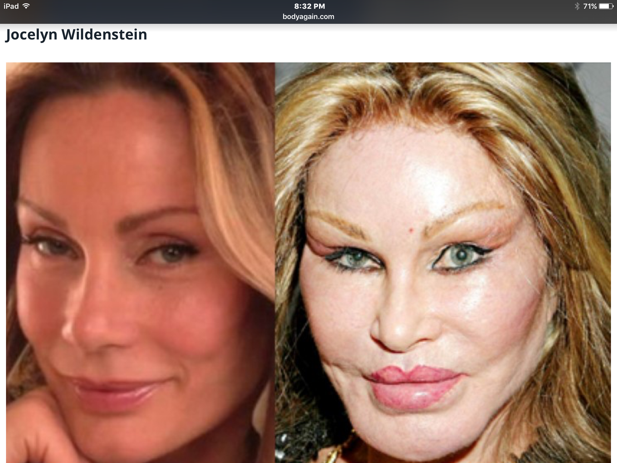 Botched Face Plastic Surgery