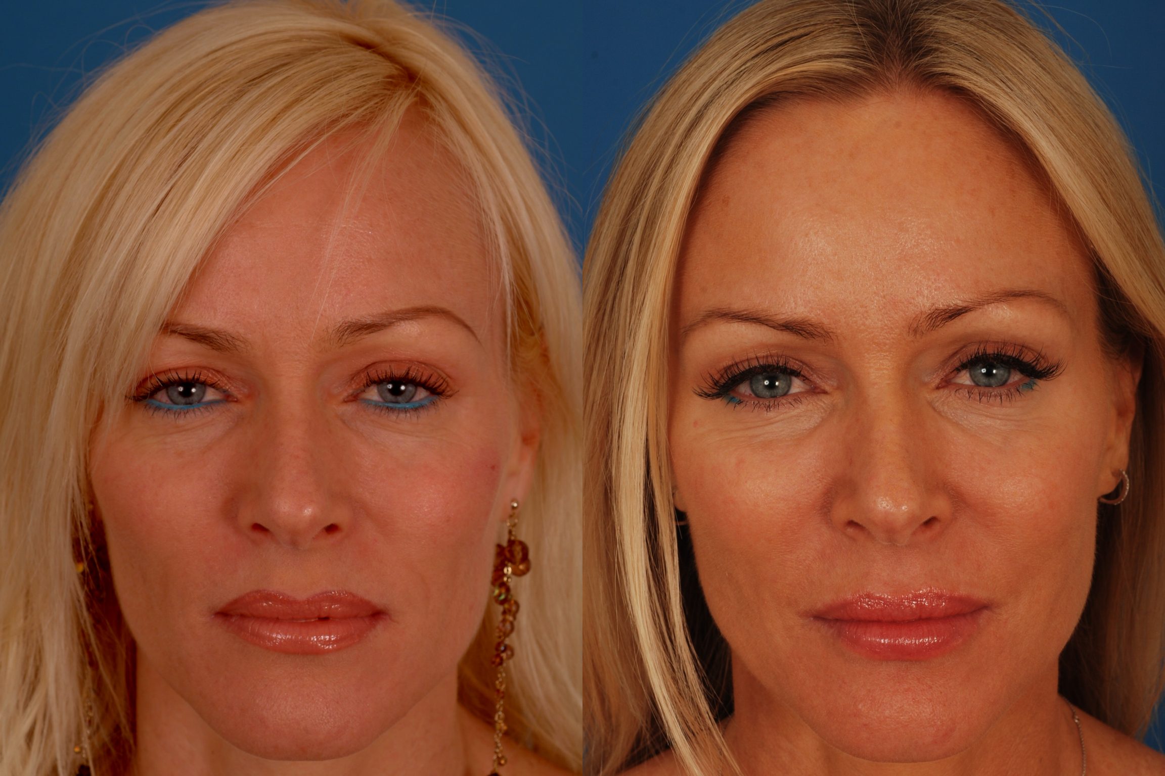 Botox Face Lift