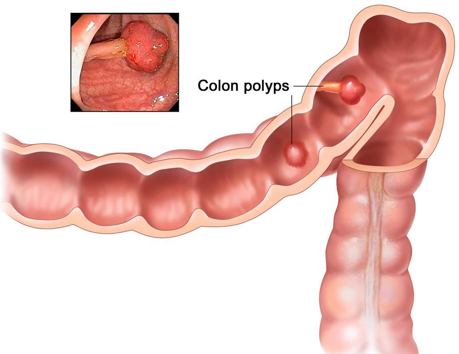 Bowel Polyps Photos