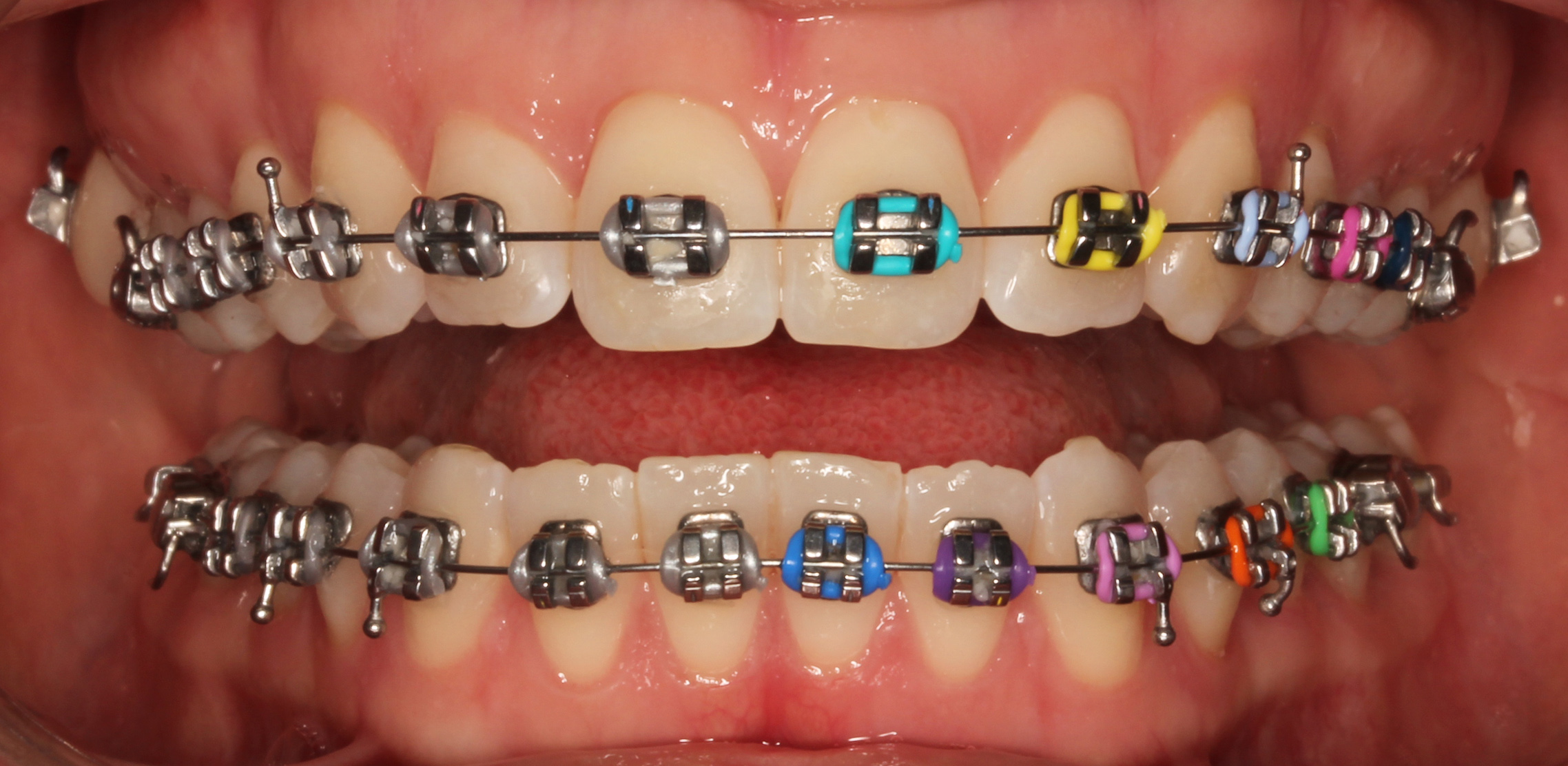 Braces Metal Braces