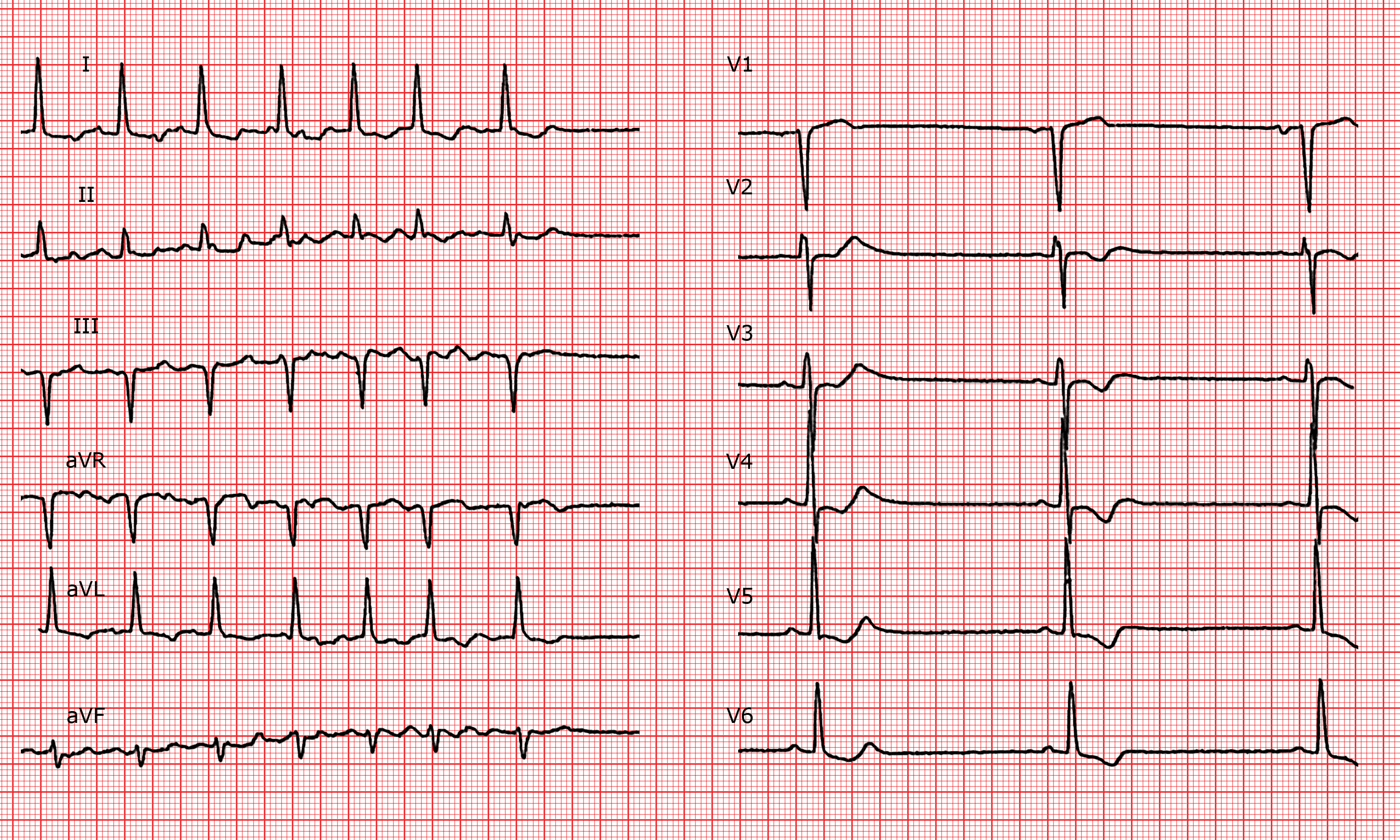 Brady Tachy Syndrome Ecg