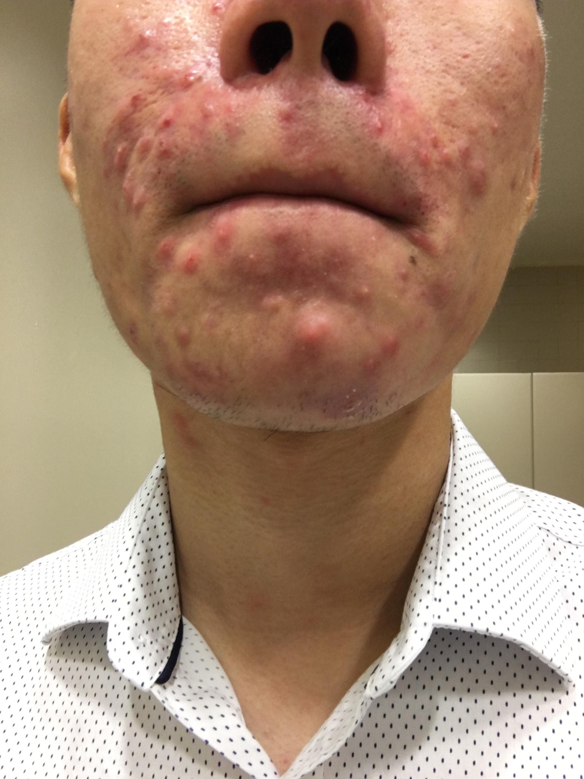 Breaking Out Around Mouth