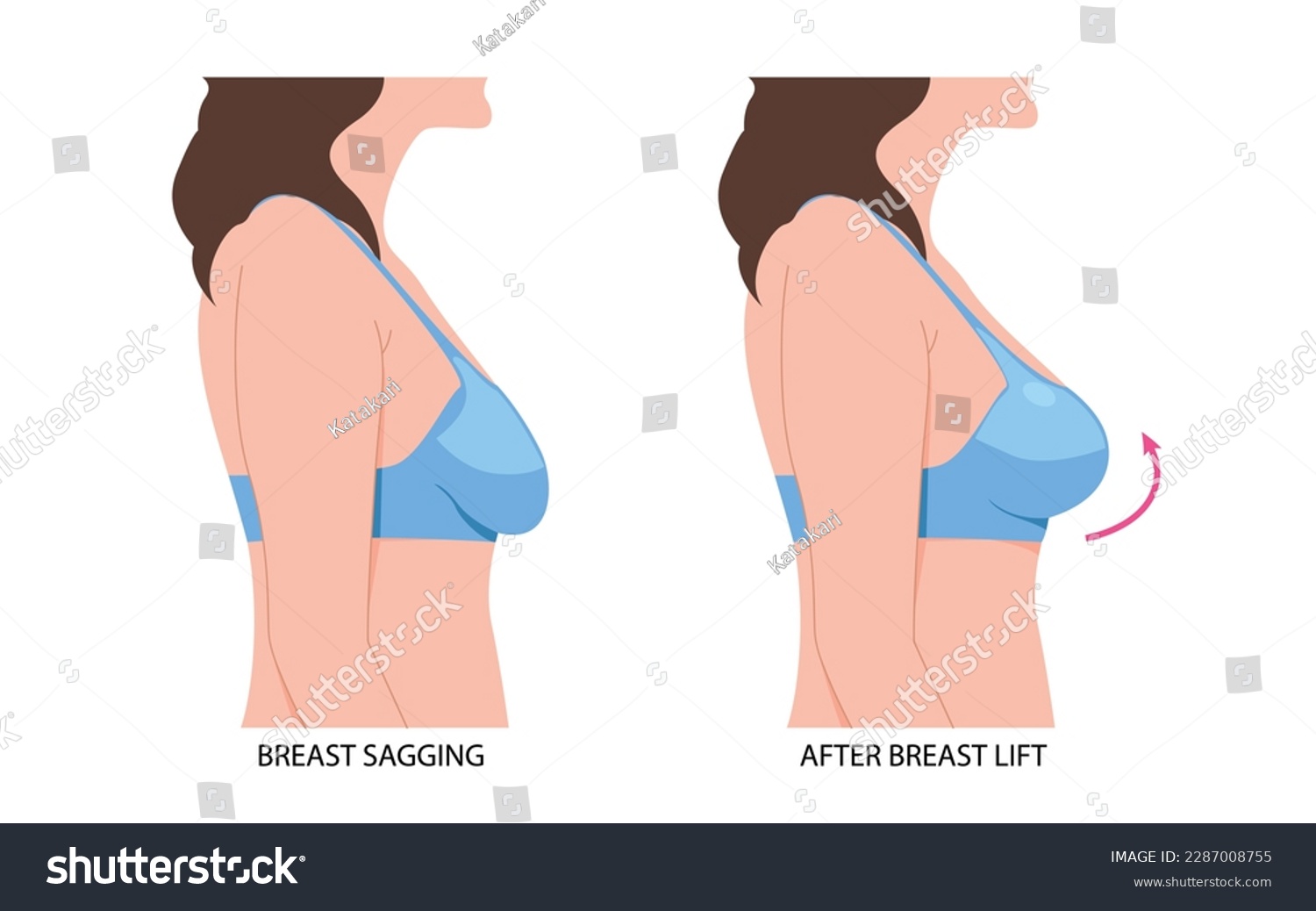 Breast Lift With Fat Transfer